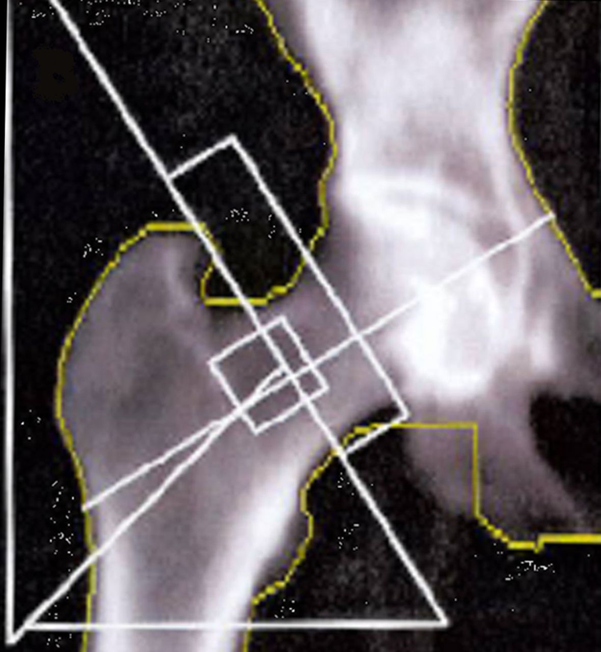 Figs. 2a - 2b 
          Images showing the regions of interest
for the assessment of bone mineral density in a) the affected hip
and b) the contralateral hip.
        