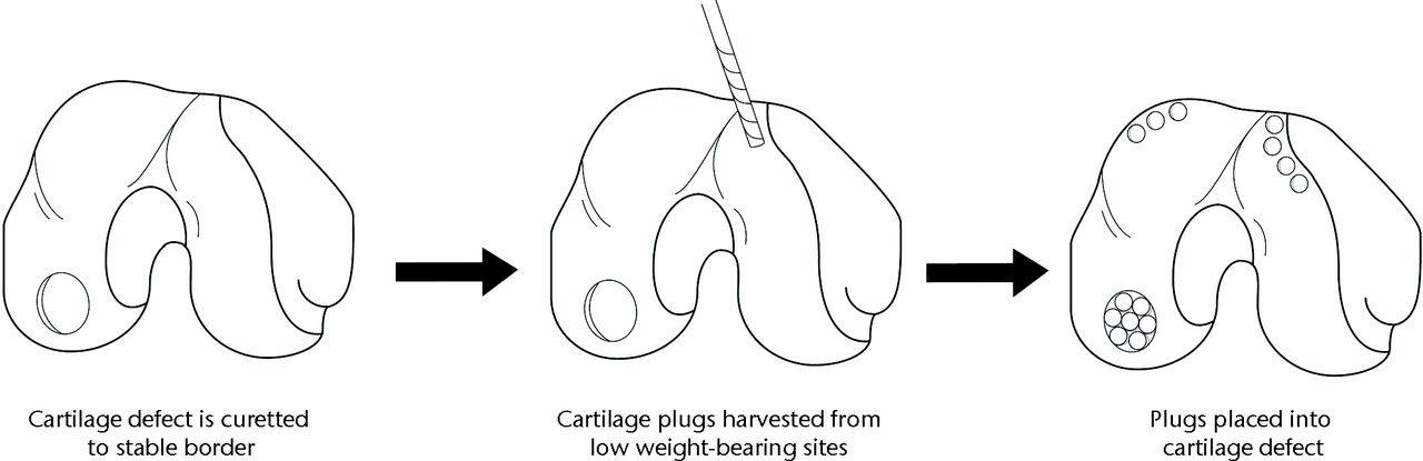 Fig. 1 
        Schematic of the autogenous osteochondral
transplantation (AOT) procedure.
      