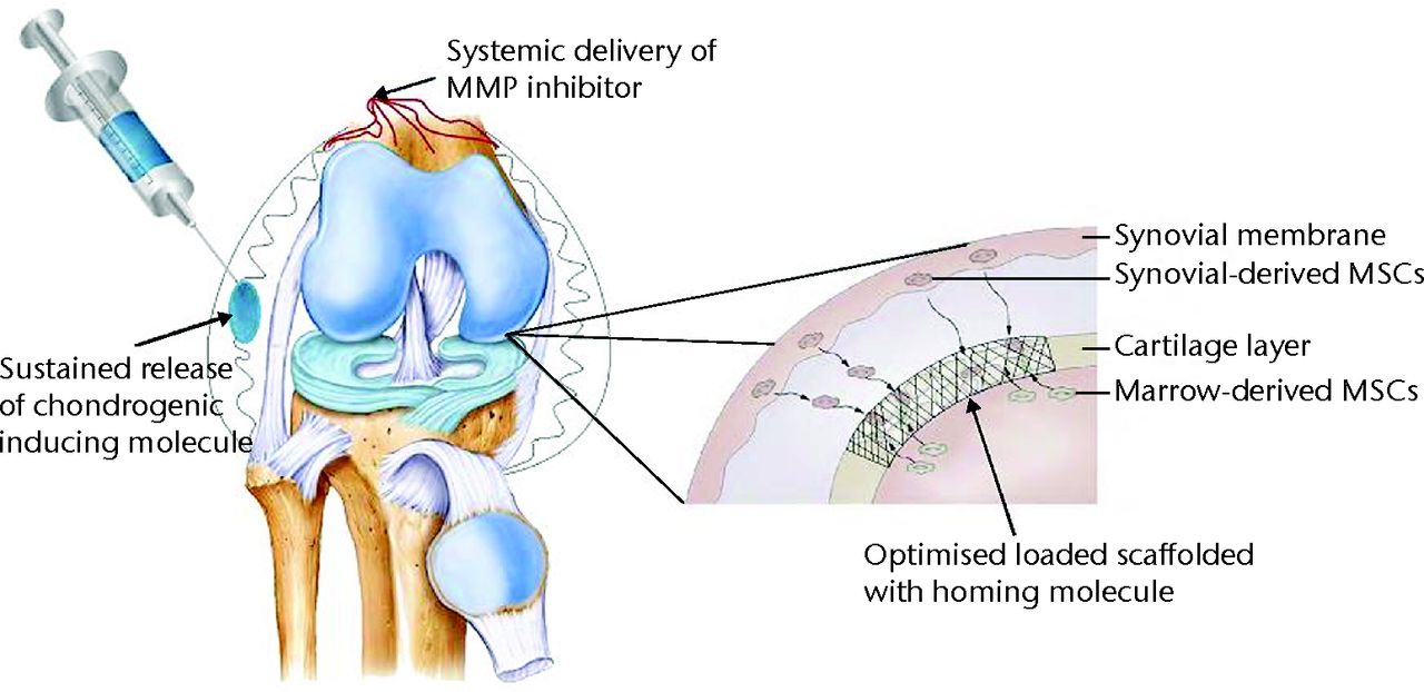 Fig. 3 
        Diagram showing an example of an integrated
approach to cartilage regeneration combining a scaffold structure
coated with a homing molecule with local and systemic chemotactic
and chondrogenic agents (MMP, matrix metalloproteinase; MSC, mesenchymal
stem cell).
      