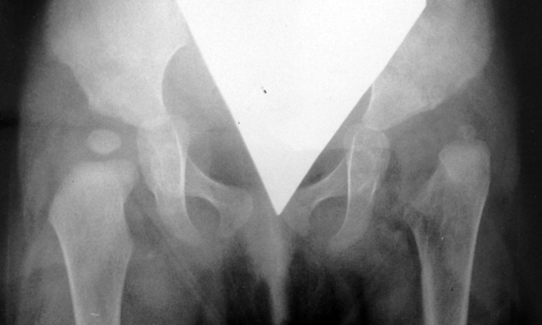 Figs. 1a - 1d 
          Anteroposterior radiographs
showing a female patient aged nine months at Ludloff open reduction,
a) pre-operatively, b) Severin group Ia of the left hip joint at
two years post-operatively, c) at ten years of age, and d) Severin
Ia with 26° of CE angle at 26 years of age. This patient did not
show subluxation or any aseptic necrosis at any time points and
therefore did not need any additional operations.
        