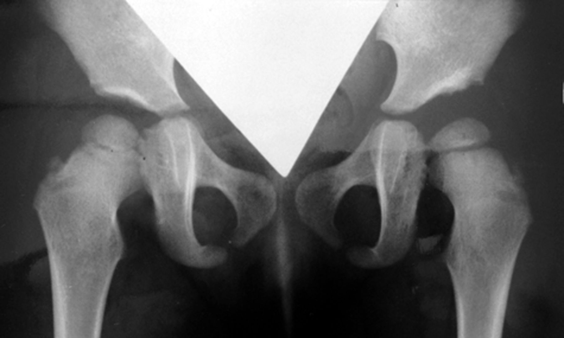 Figs. 1a - 1d 
          Anteroposterior radiographs
showing a female patient aged nine months at Ludloff open reduction,
a) pre-operatively, b) Severin group Ia of the left hip joint at
two years post-operatively, c) at ten years of age, and d) Severin
Ia with 26° of CE angle at 26 years of age. This patient did not
show subluxation or any aseptic necrosis at any time points and
therefore did not need any additional operations.
        