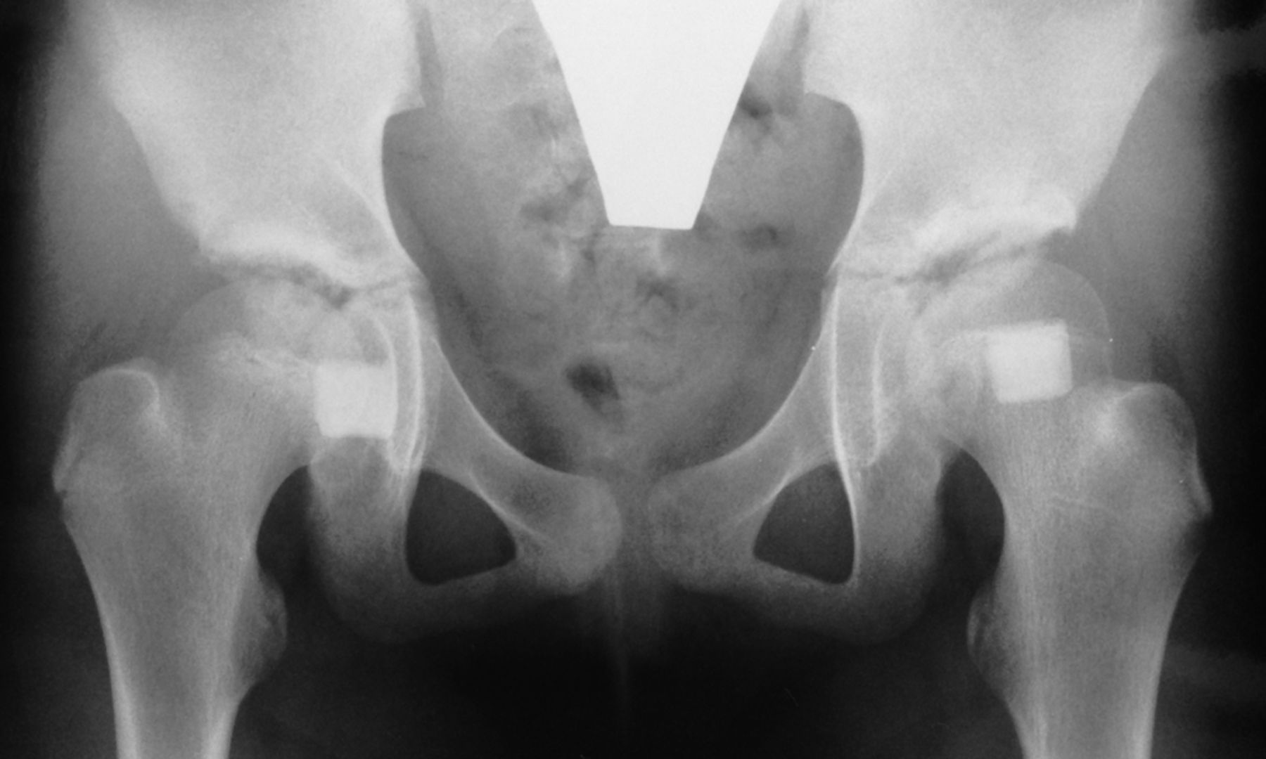 Figs. 1a - 1d 
          Anteroposterior radiographs
showing a female patient aged nine months at Ludloff open reduction,
a) pre-operatively, b) Severin group Ia of the left hip joint at
two years post-operatively, c) at ten years of age, and d) Severin
Ia with 26° of CE angle at 26 years of age. This patient did not
show subluxation or any aseptic necrosis at any time points and
therefore did not need any additional operations.
        