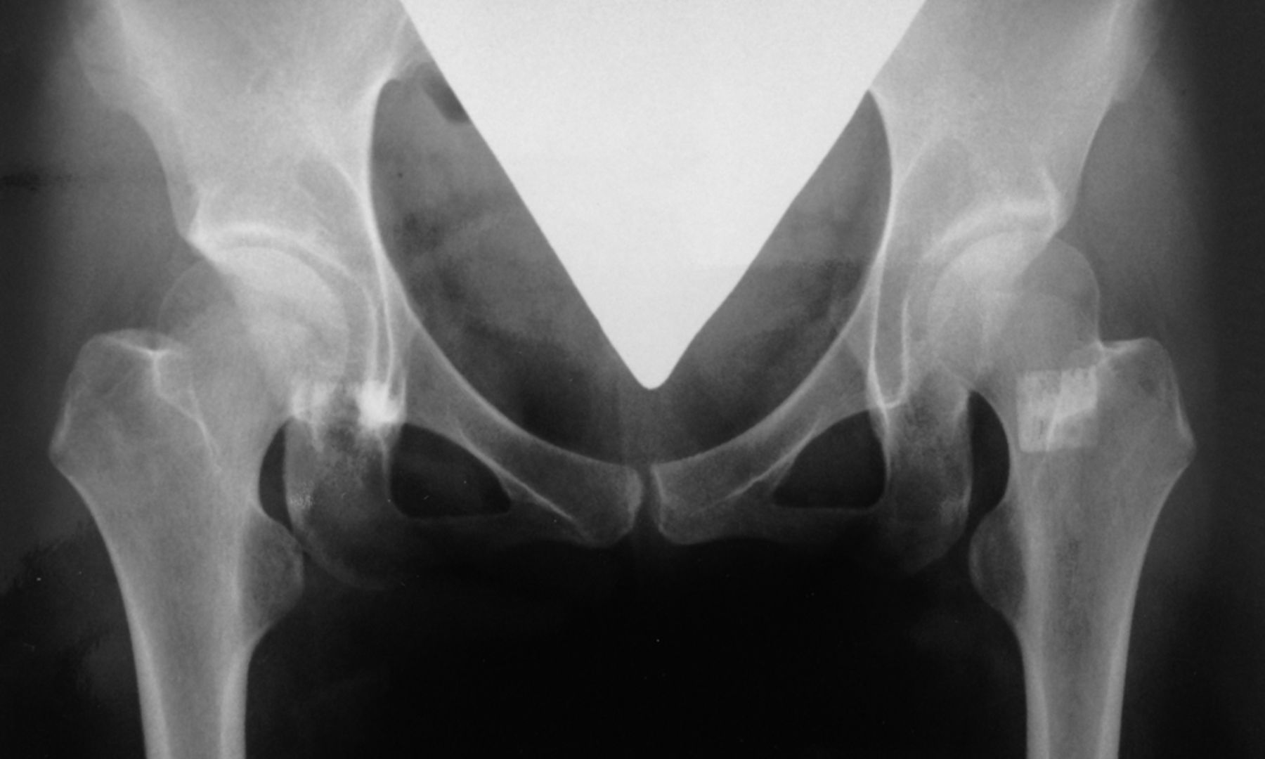 Figs. 1a - 1d 
          Anteroposterior radiographs
showing a female patient aged nine months at Ludloff open reduction,
a) pre-operatively, b) Severin group Ia of the left hip joint at
two years post-operatively, c) at ten years of age, and d) Severin
Ia with 26° of CE angle at 26 years of age. This patient did not
show subluxation or any aseptic necrosis at any time points and
therefore did not need any additional operations.
        