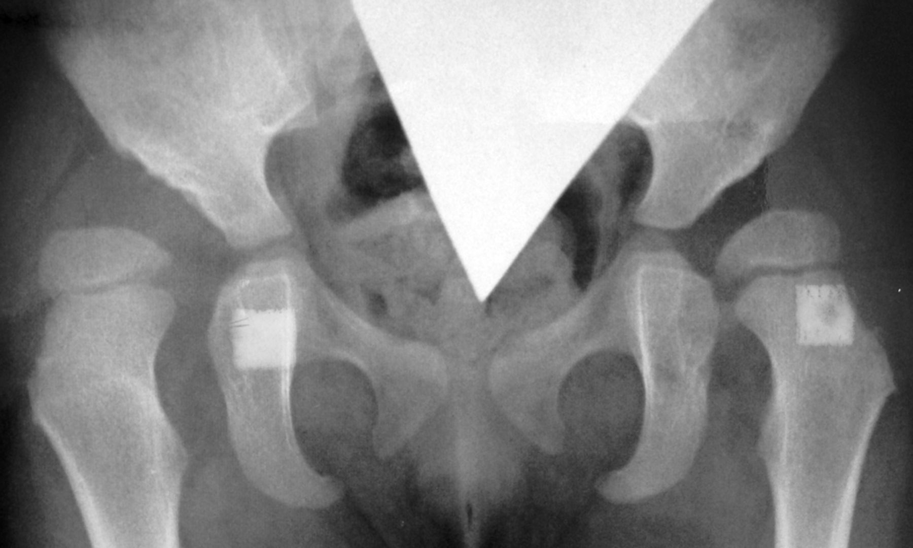 Figs. 3a - 3d 
          Anteroposterior radiographs
of a female patient who underwent bilateral Ludloff open reduction
aged 5 months; a) at 1.6 years post-operatively, showing advanced
subluxation of the femoral head and residual acetabular dysplasia;
b) two months after bilateral Salter and femoral derotation varus
osteotomies;c) after recurrence of coxa valga without aseptic necrosis
at nine years of age and d) Severin group IIa of both hips at 28
years of age.
        