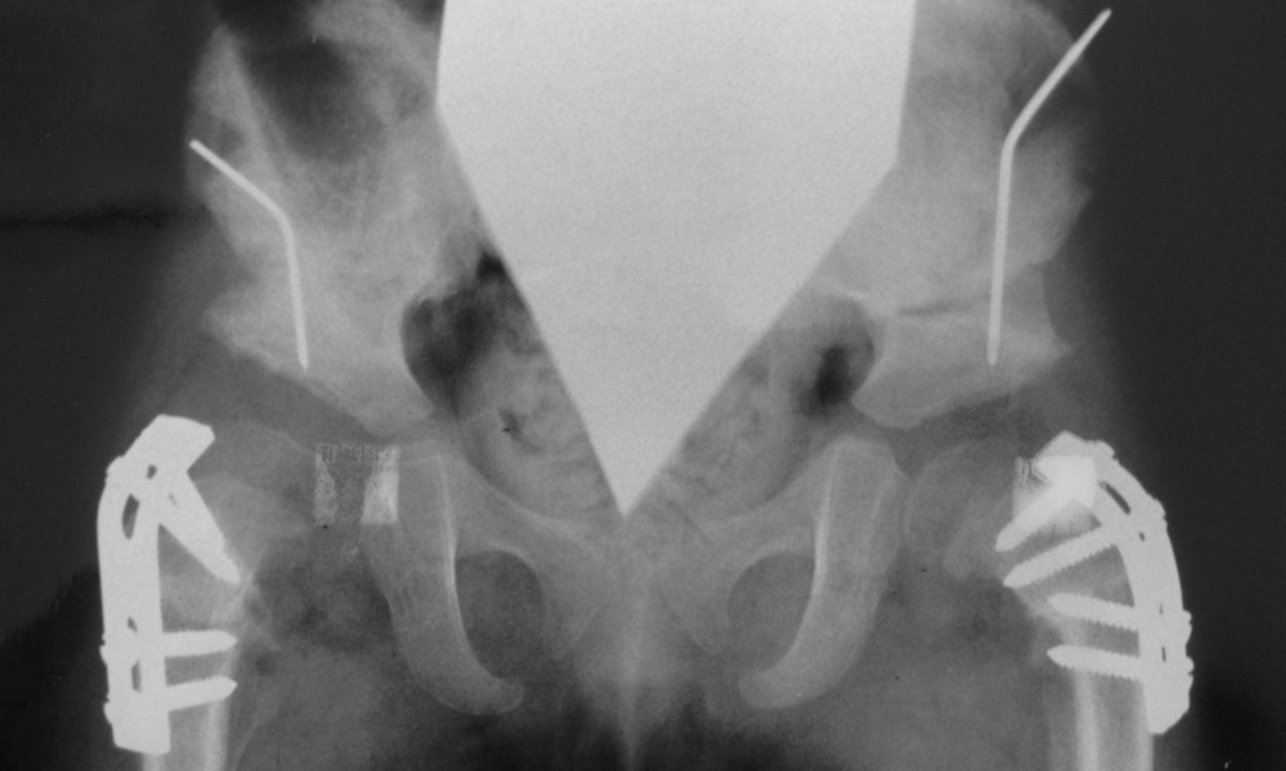 Figs. 3a - 3d 
          Anteroposterior radiographs
of a female patient who underwent bilateral Ludloff open reduction
aged 5 months; a) at 1.6 years post-operatively, showing advanced
subluxation of the femoral head and residual acetabular dysplasia;
b) two months after bilateral Salter and femoral derotation varus
osteotomies;c) after recurrence of coxa valga without aseptic necrosis
at nine years of age and d) Severin group IIa of both hips at 28
years of age.
        