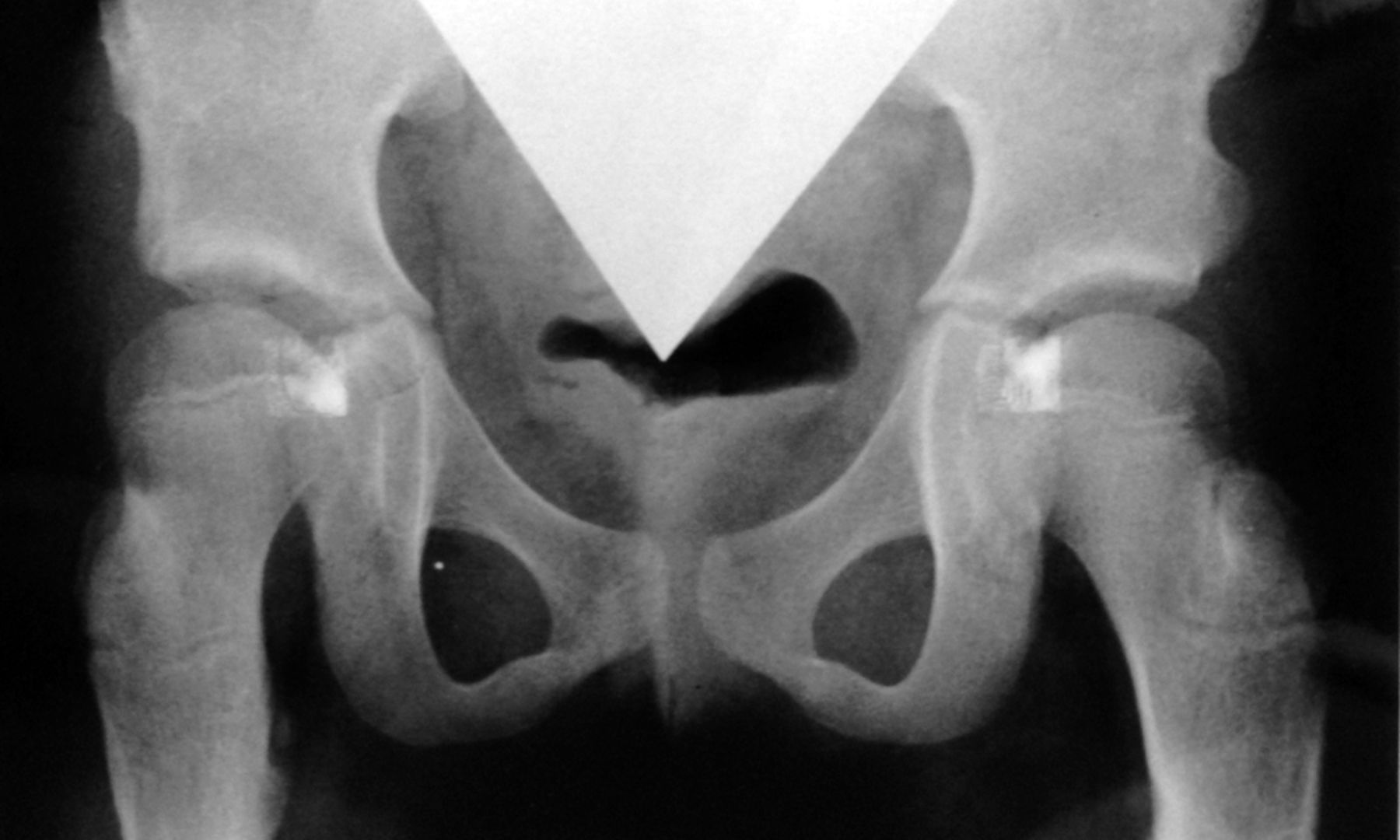 Figs. 3a - 3d 
          Anteroposterior radiographs
of a female patient who underwent bilateral Ludloff open reduction
aged 5 months; a) at 1.6 years post-operatively, showing advanced
subluxation of the femoral head and residual acetabular dysplasia;
b) two months after bilateral Salter and femoral derotation varus
osteotomies;c) after recurrence of coxa valga without aseptic necrosis
at nine years of age and d) Severin group IIa of both hips at 28
years of age.
        