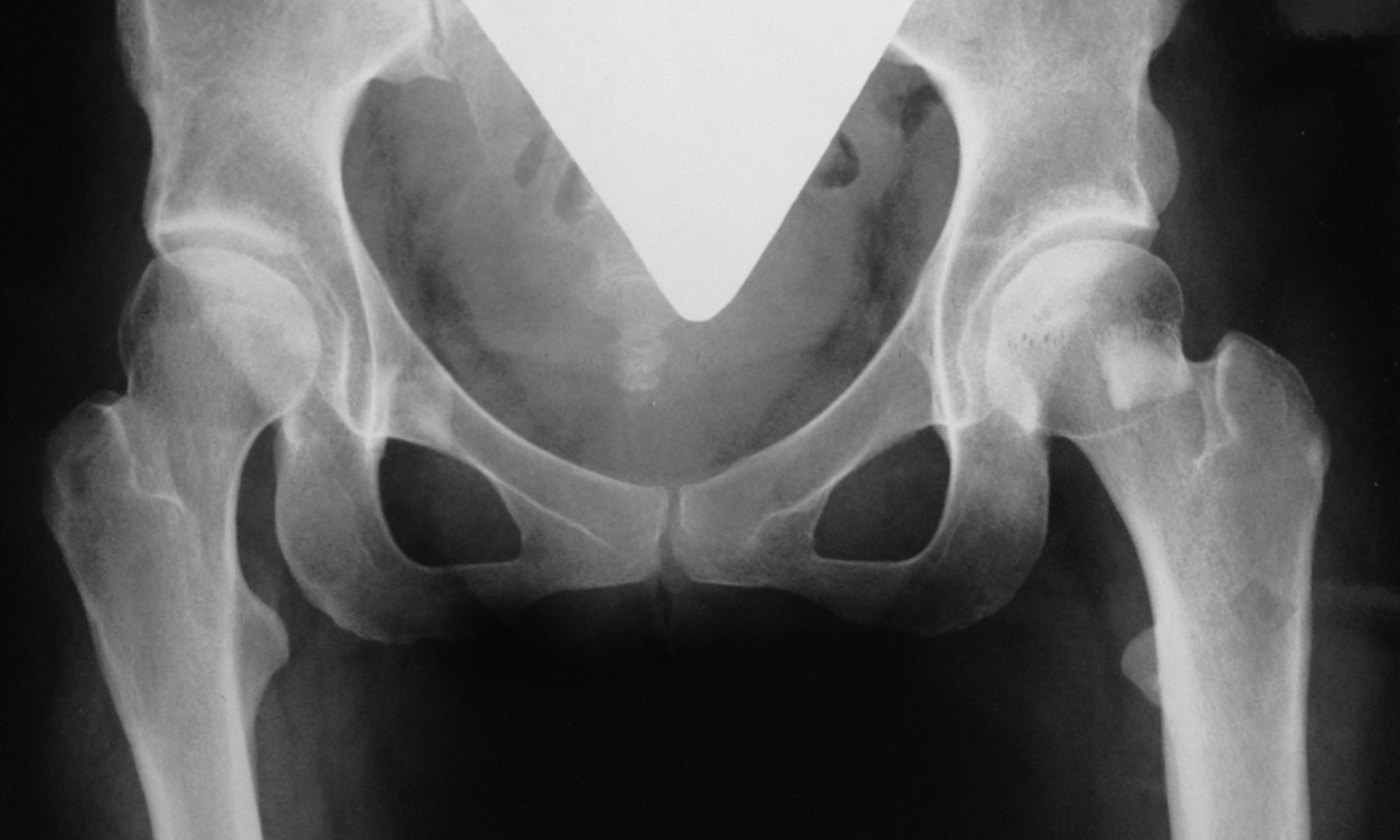 Figs. 3a - 3d 
          Anteroposterior radiographs
of a female patient who underwent bilateral Ludloff open reduction
aged 5 months; a) at 1.6 years post-operatively, showing advanced
subluxation of the femoral head and residual acetabular dysplasia;
b) two months after bilateral Salter and femoral derotation varus
osteotomies;c) after recurrence of coxa valga without aseptic necrosis
at nine years of age and d) Severin group IIa of both hips at 28
years of age.
        