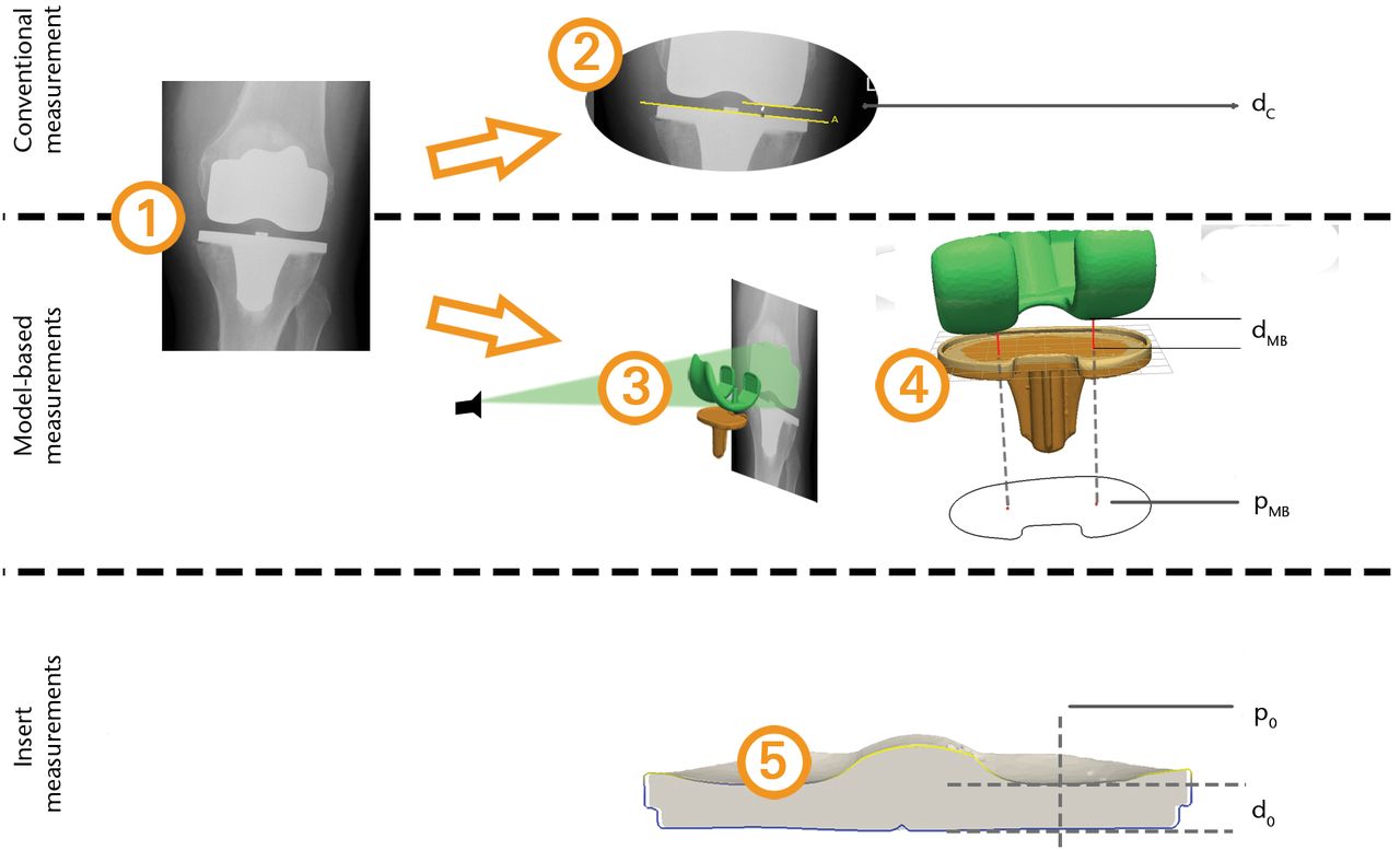 Fig. 1 
            Overview of the measurement methods
applied for a single total knee replacement (TKR). The rows in the
figure represent the measurement methods that were compared: 1)
the input radiograph; 2) the conventional insert thickness measurement;
3) 2D/3D matching of the component models; 4) model-based mJSW measurement;
5) the minimum insert thickness and location based on the 3D laser
scan of the insert.
          