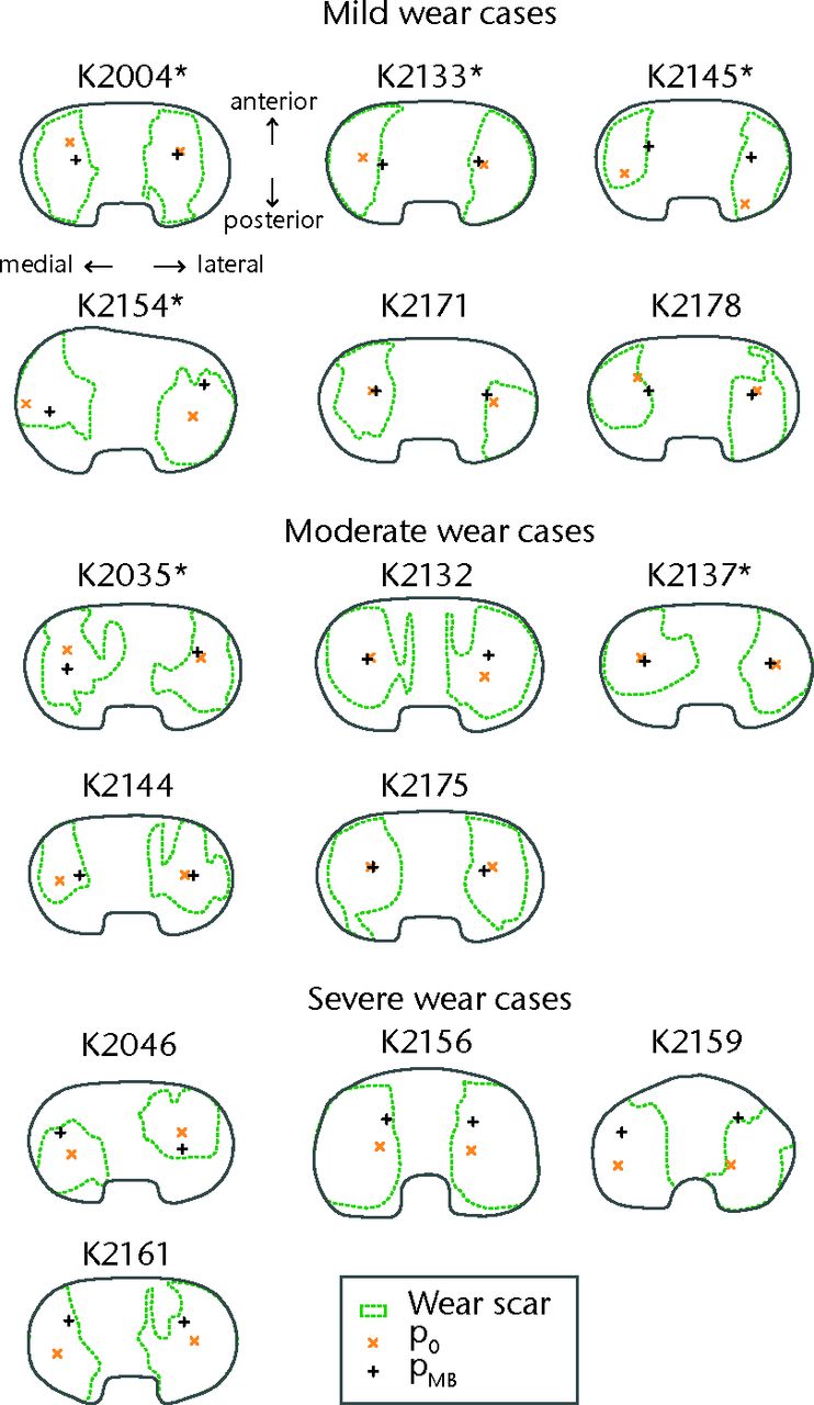 Fig. 4 
            Illustrations of the articular surfaces
of each explanted insert, showing the wear scar peripheries and
locations of the minimum insert thickness (p0) and the
femoral contact (pMB). These illustrations are plotted
as looking down on the superior surface of a right knee, with the
medial condyle always at the left side of the image. Illustrations
of inserts originating from left TKR are mirrored to fit this convention
and are indicated with an asterisk (*) after the case number.
          