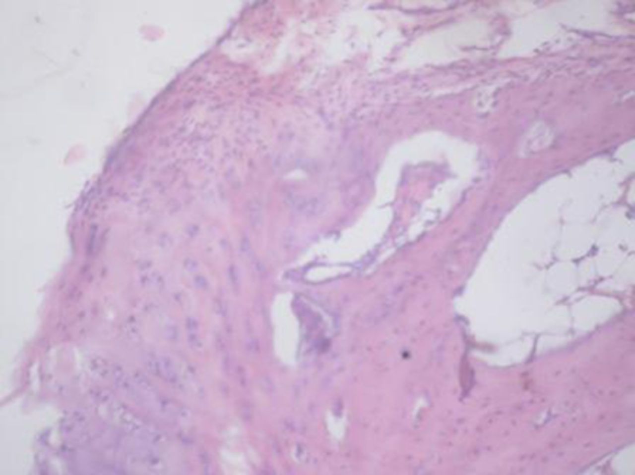 Figs. 2a - 2d 
            
              Figures 2a and 2b – histological
images of articular cartilage in the mesenchymal stem cell (MSC)-treated
group a) at 16 weeks and b) at 20 weeks post-operatively, showing
appropriate thickness, normal distribution of the cells and consistent
staining of the cartilage, with the surface layer showing very mild
irregularity (haematoxylin and eosin, ×40). Figures 2c and 2d –
histological images of articular cartilage in the control group
c) at 16 weeks and d) at 20 weeks post-operatively, showing structural
disorganisation and severe hypocellularity of chondrocytes.
          