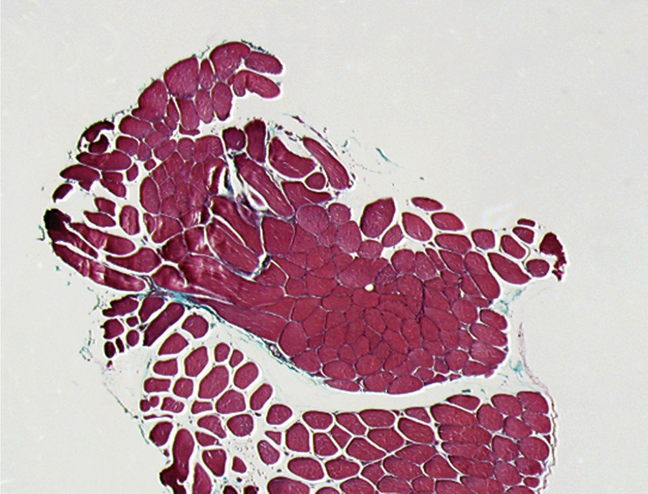 Figs. 2a - 2b 
          Histological images showing Masson’s
trichrome staining of a representative muscle biopsy a) pre- and
b) three months post-transplantation (magnification 5×).
        