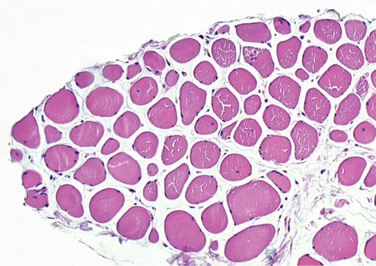 Figs. 4a - 4h 
          Histological images
for specimens taken pre-transplantation (left column) and at three
months follow-up (right column), showing staining of a representative muscle
biopsy with haematoxylin and eosin (a and b; ×20), Pax7 (c and d,
×40), vWF (e and f, ×40) and CD56 (g and h, ×40).
        