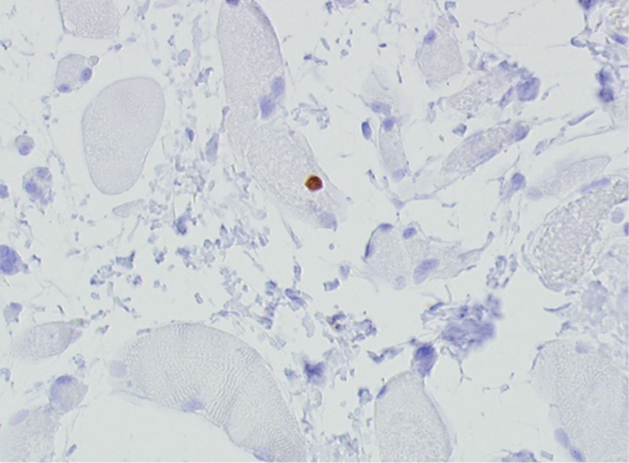 Figs. 4a - 4h 
          Histological images
for specimens taken pre-transplantation (left column) and at three
months follow-up (right column), showing staining of a representative muscle
biopsy with haematoxylin and eosin (a and b; ×20), Pax7 (c and d,
×40), vWF (e and f, ×40) and CD56 (g and h, ×40).
        