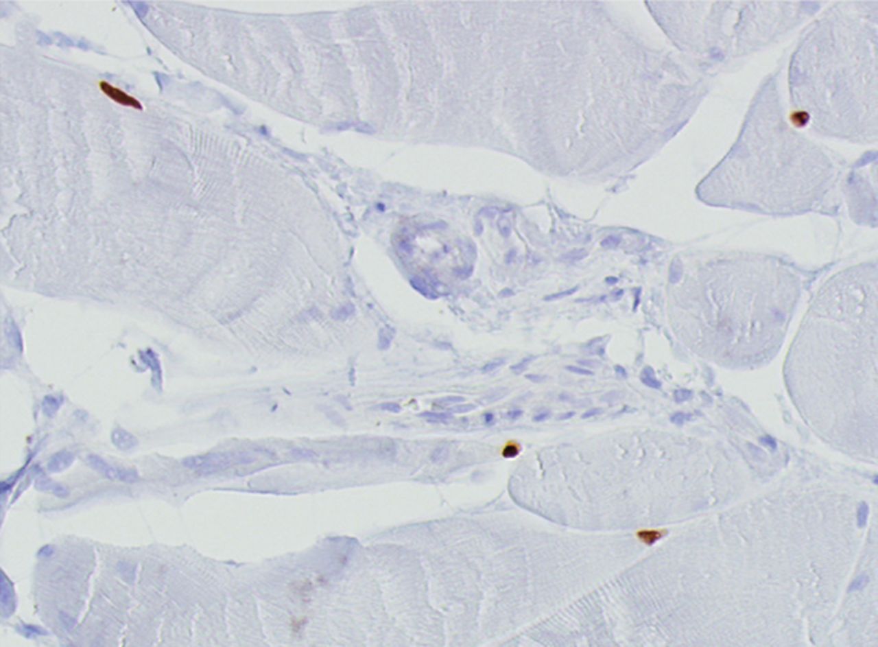 Figs. 4a - 4h 
          Histological images
for specimens taken pre-transplantation (left column) and at three
months follow-up (right column), showing staining of a representative muscle
biopsy with haematoxylin and eosin (a and b; ×20), Pax7 (c and d,
×40), vWF (e and f, ×40) and CD56 (g and h, ×40).
        