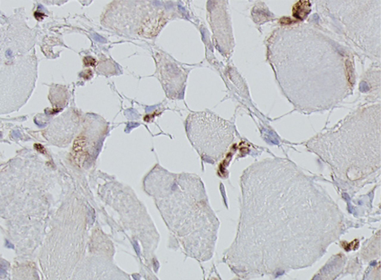 Figs. 4a - 4h 
          Histological images
for specimens taken pre-transplantation (left column) and at three
months follow-up (right column), showing staining of a representative muscle
biopsy with haematoxylin and eosin (a and b; ×20), Pax7 (c and d,
×40), vWF (e and f, ×40) and CD56 (g and h, ×40).
        