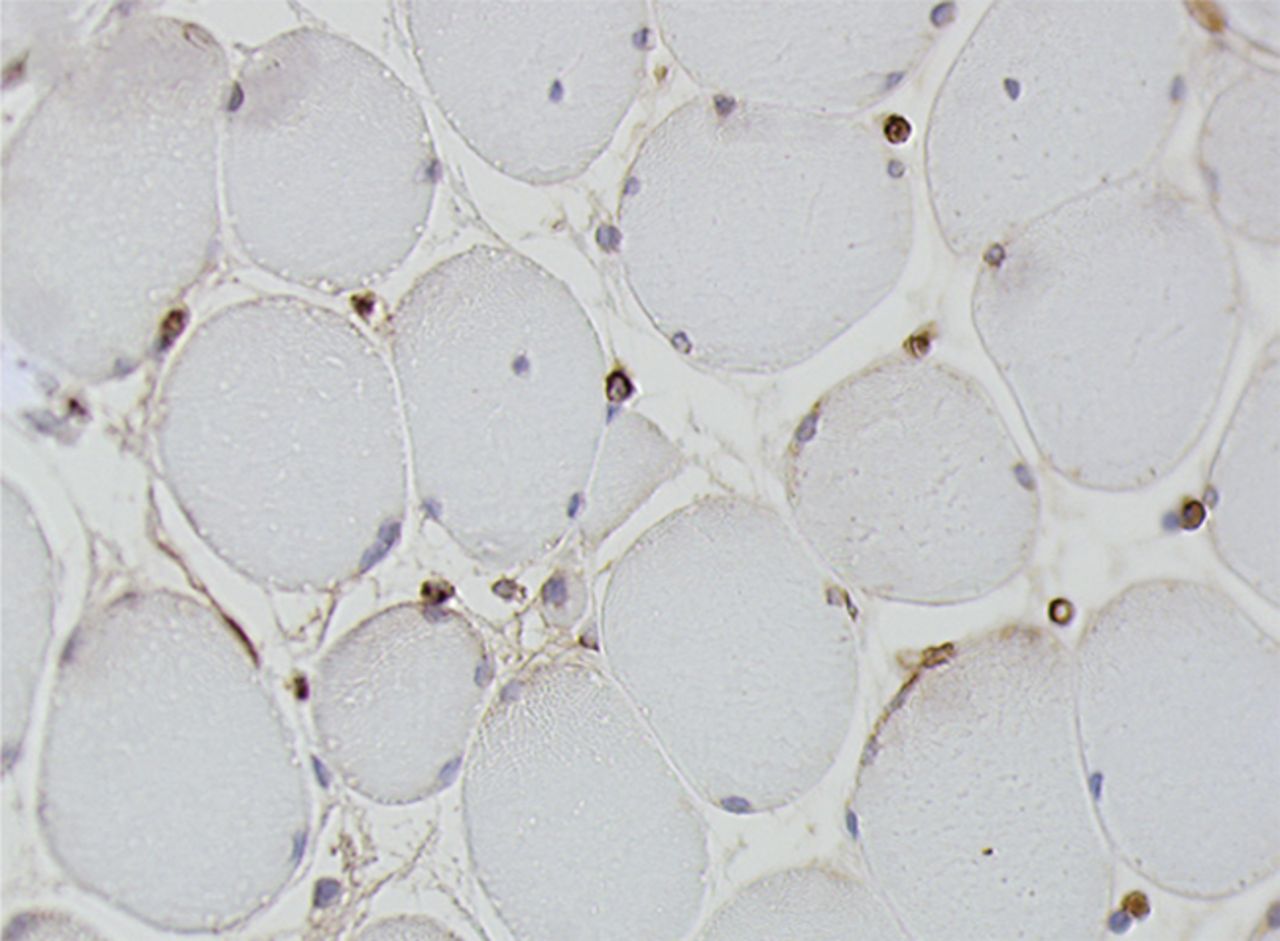 Figs. 4a - 4h 
          Histological images
for specimens taken pre-transplantation (left column) and at three
months follow-up (right column), showing staining of a representative muscle
biopsy with haematoxylin and eosin (a and b; ×20), Pax7 (c and d,
×40), vWF (e and f, ×40) and CD56 (g and h, ×40).
        