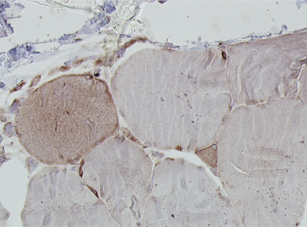 Figs. 4a - 4h 
          Histological images
for specimens taken pre-transplantation (left column) and at three
months follow-up (right column), showing staining of a representative muscle
biopsy with haematoxylin and eosin (a and b; ×20), Pax7 (c and d,
×40), vWF (e and f, ×40) and CD56 (g and h, ×40).
        