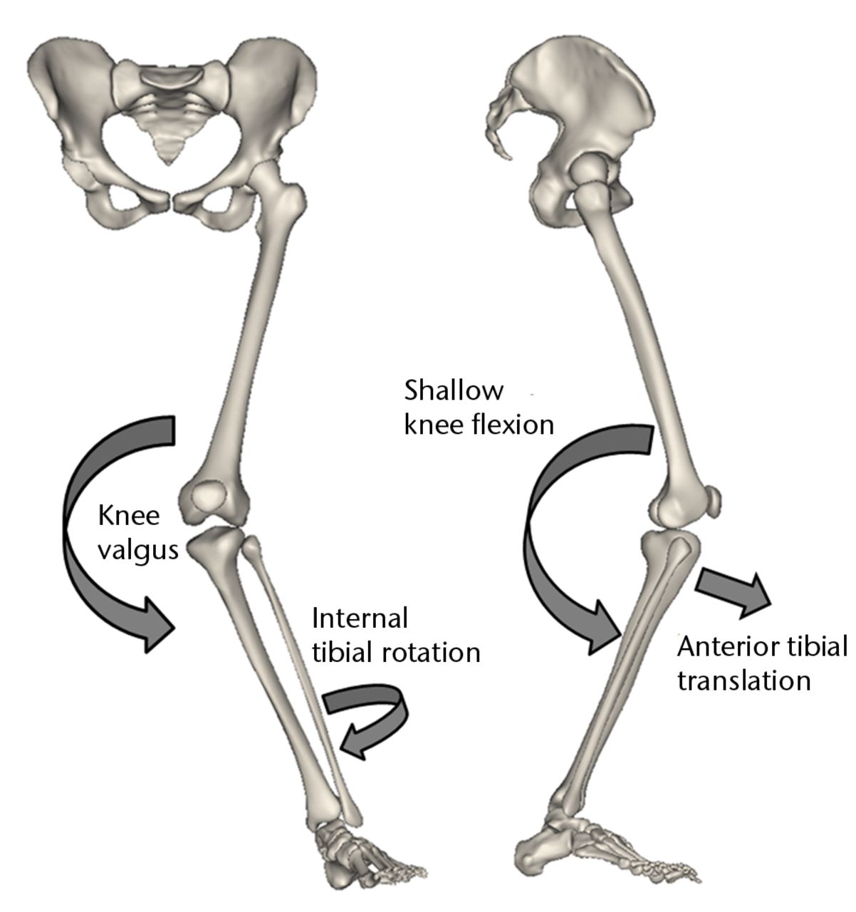 Fig. 1 
          Schematic showing the multi-planar loading
mechanism of non-contact injury to the anterior cruciate ligament
(Adapted and modified with permission from Levine et al3).
        