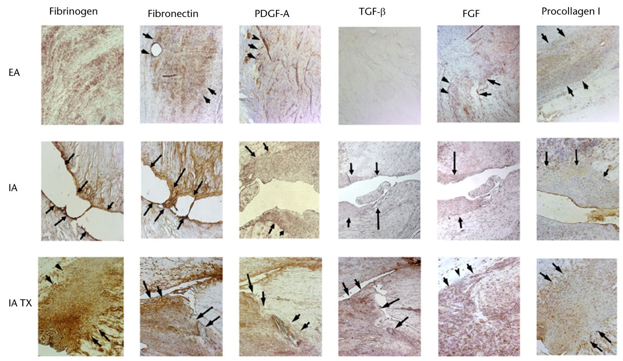 Fig. 3 
          Representative photomicrographs of patellar
ligament wounds (extra-articular, EA), untreated anterior cruciate
ligament (ACL) wounds (intra-articular, IA) and treated ACL with
collagen-platelet scaffold (IA Tx) at 21 days after injury (10x).
Treated ACLs show similar distribution of protein presence as the
patellar ligament. The untreated ACL wounds remain with almost no
substratum (PDGF-A: platelet-derived growth factor; TGF-β: transforming
growth factor; FGF: ﬁbroblast growth factor) (adapted and modified
with permission from Murray et al75).
        