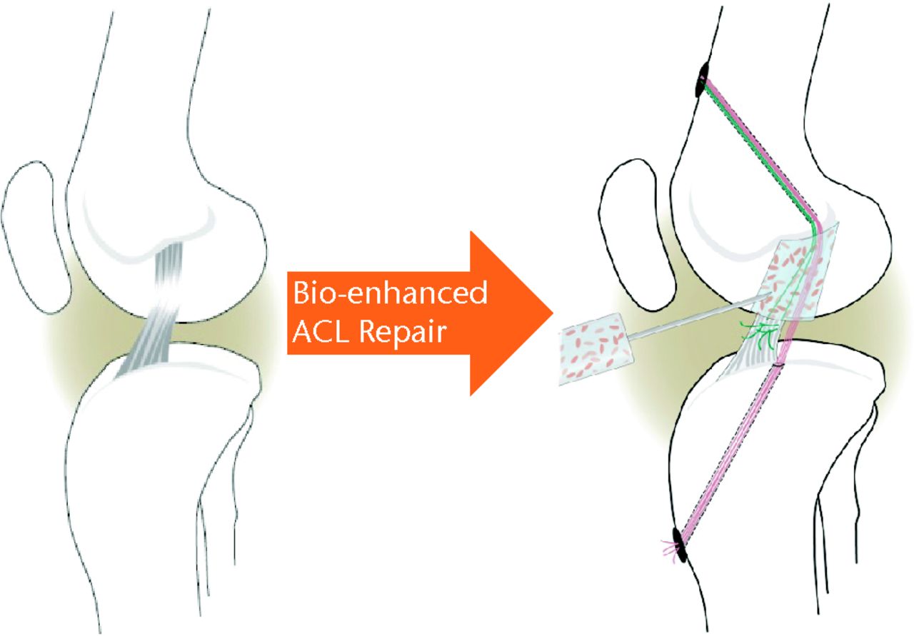 Fig. 4 
          Schematic of bio-enhanced anterior cruciate
ligament (ACL) repair method (adapted and modified with permission
from Murray and Fleming182).
        