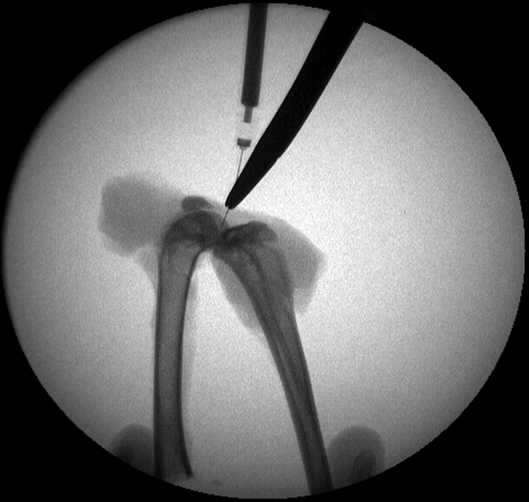 Figs. 3a - 3b 
          Intra-operative fluoroscopic images
confirming a) intra-articular placement of needle, and b) subsequent injection
of decorin or bovine serum albumin (BSA).
        