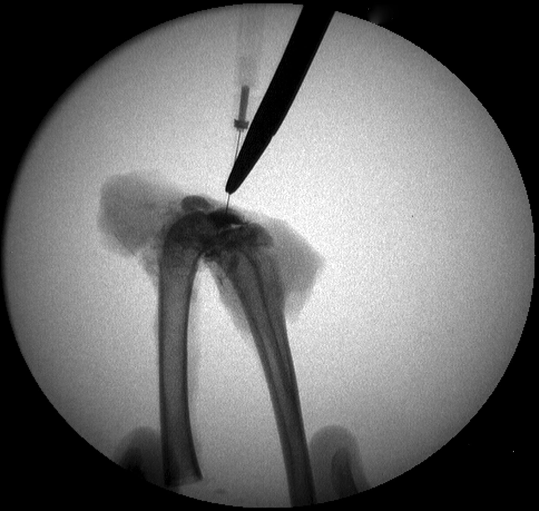 Figs. 3a - 3b 
          Intra-operative fluoroscopic images
confirming a) intra-articular placement of needle, and b) subsequent injection
of decorin or bovine serum albumin (BSA).
        