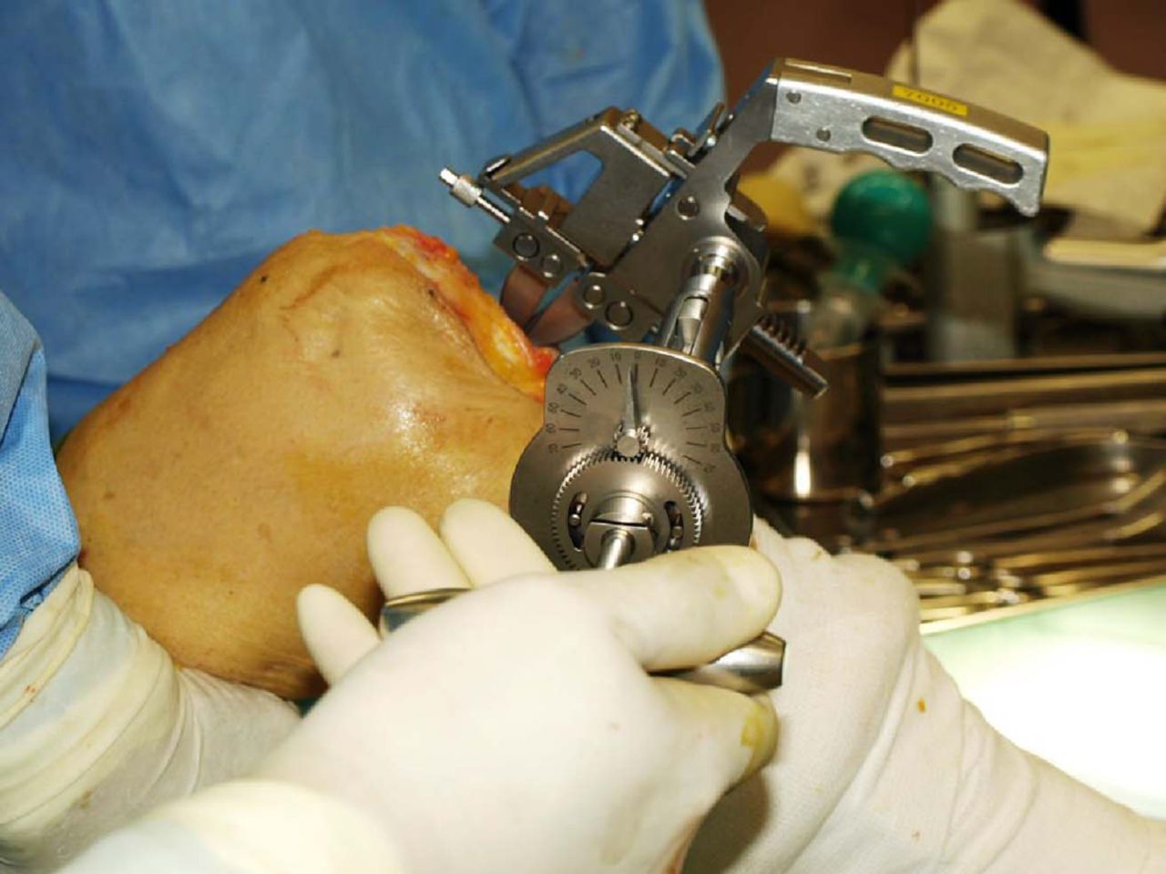 Fig. 2 
          Intra-operative photograph showing measurement
of the flexion gap with the patella reduced.
        