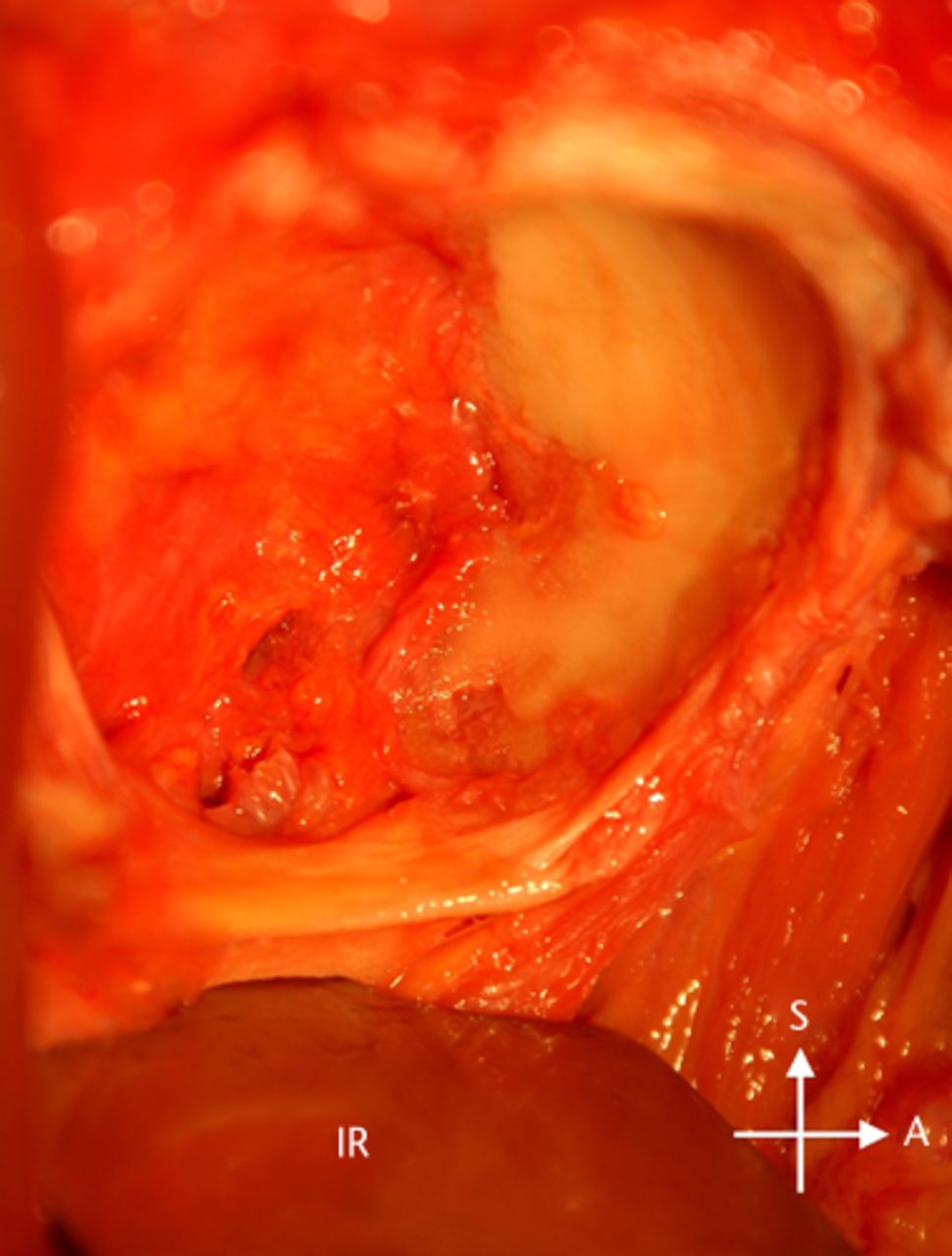 Fig. 2 
          Photograph showing the inferior retractor
(IR) placed under the transverse acetabulum ligament, around the
inferior wall of the acetabulum.
        