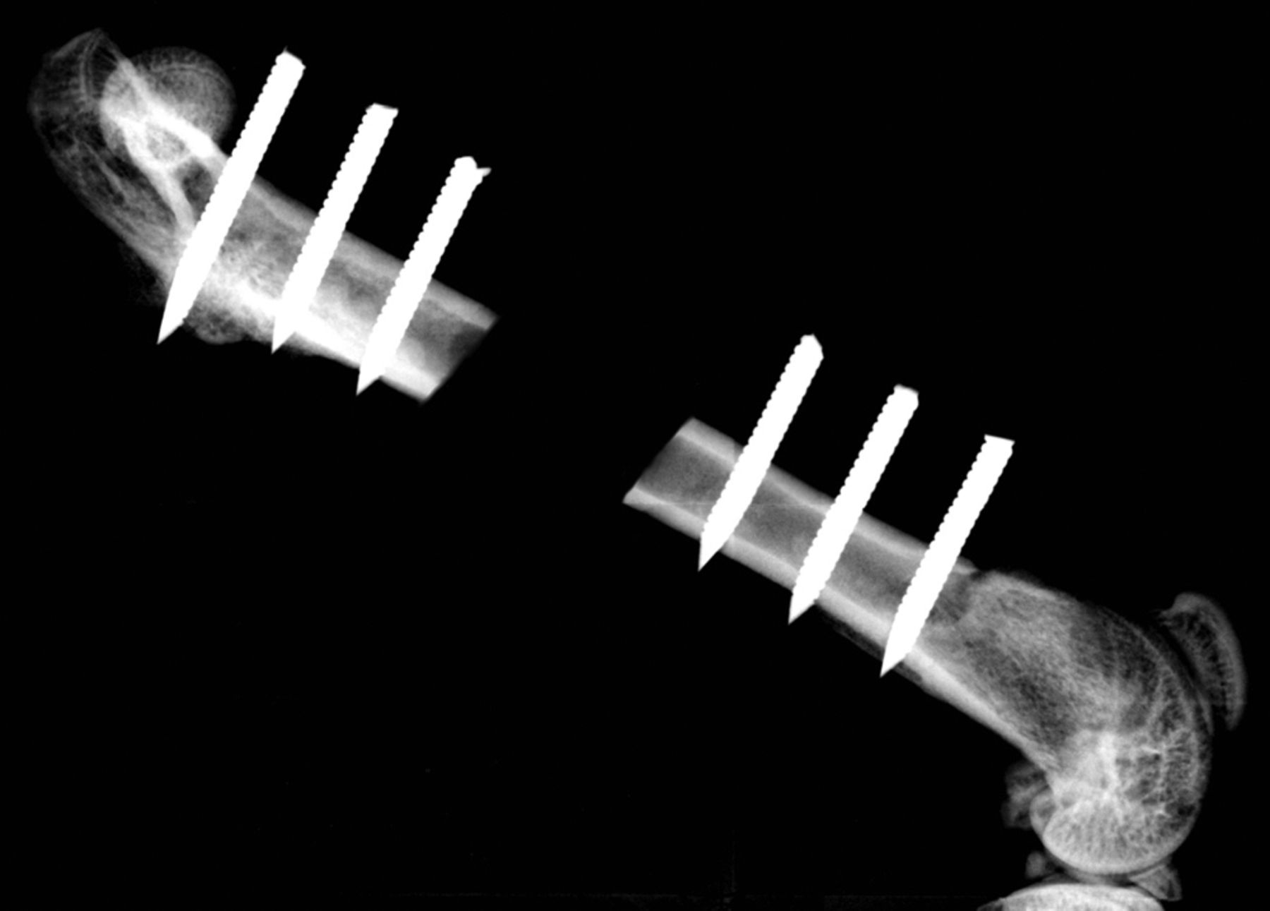 Fig. 1 
          Radiograph showing a 6 mm defect
in a rat femur stabilised by a radiolucent polyoxymethylene plate
secured with six threaded 0.9 mm K-wires.
        