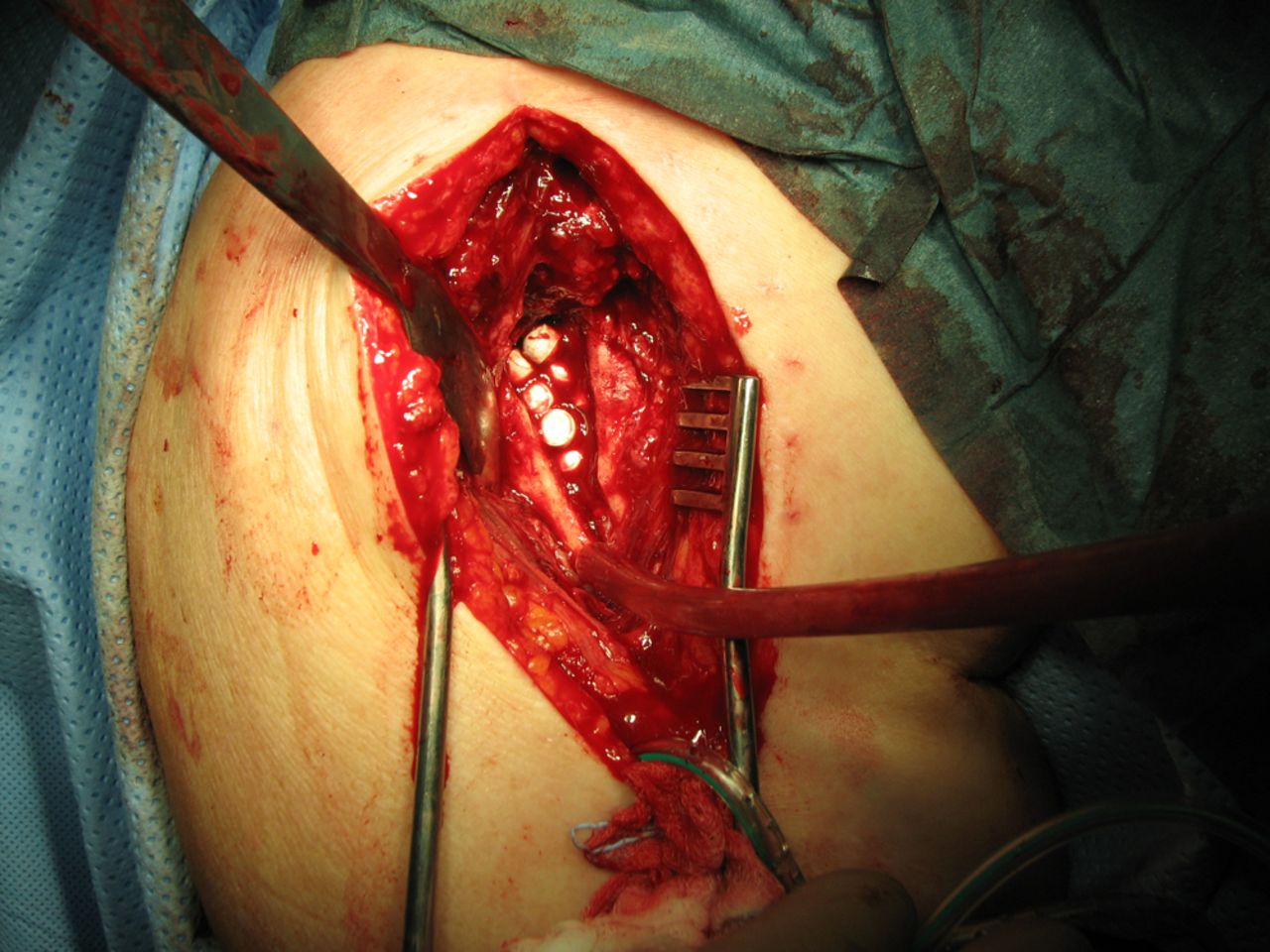 Figs. 1a - 1b 
            Figure 1a – photograph showing in
situ demonstration of applied beads in a debrided bone
void. Figure 1b – radiograph of the implant’s position in a chronically
infected tibial zone. 
          