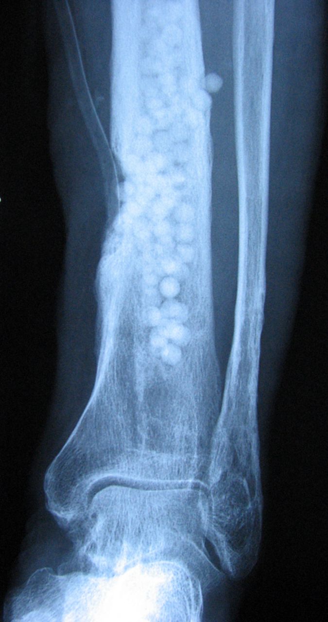 Figs. 1a - 1b 
            Figure 1a – photograph showing in
situ demonstration of applied beads in a debrided bone
void. Figure 1b – radiograph of the implant’s position in a chronically
infected tibial zone. 
          