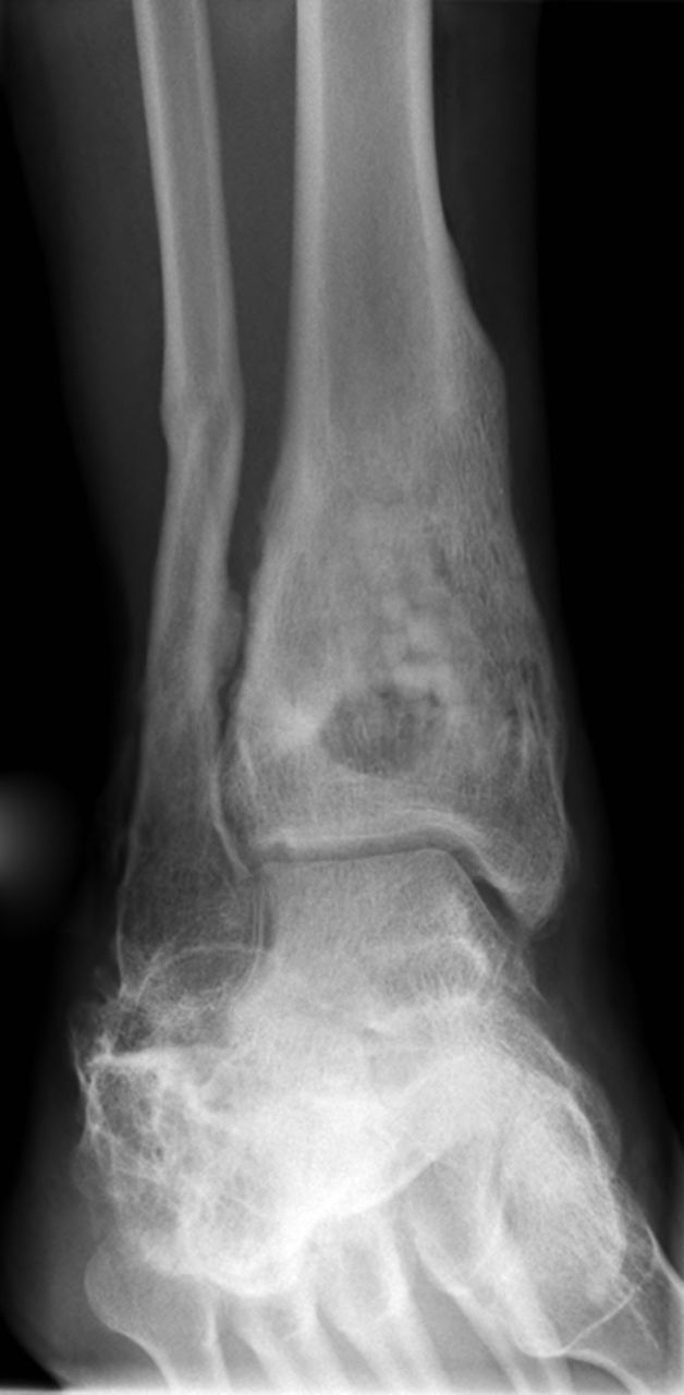 Figs. 5a - 5d 
            Radiographs showing HERAFILL®
beads G (Heraeus Medical GmbH) after implantation into a distal
tibial bone void a) pre-operatively, b) post-operatively, c) three
and d) six months post-operatively.
          