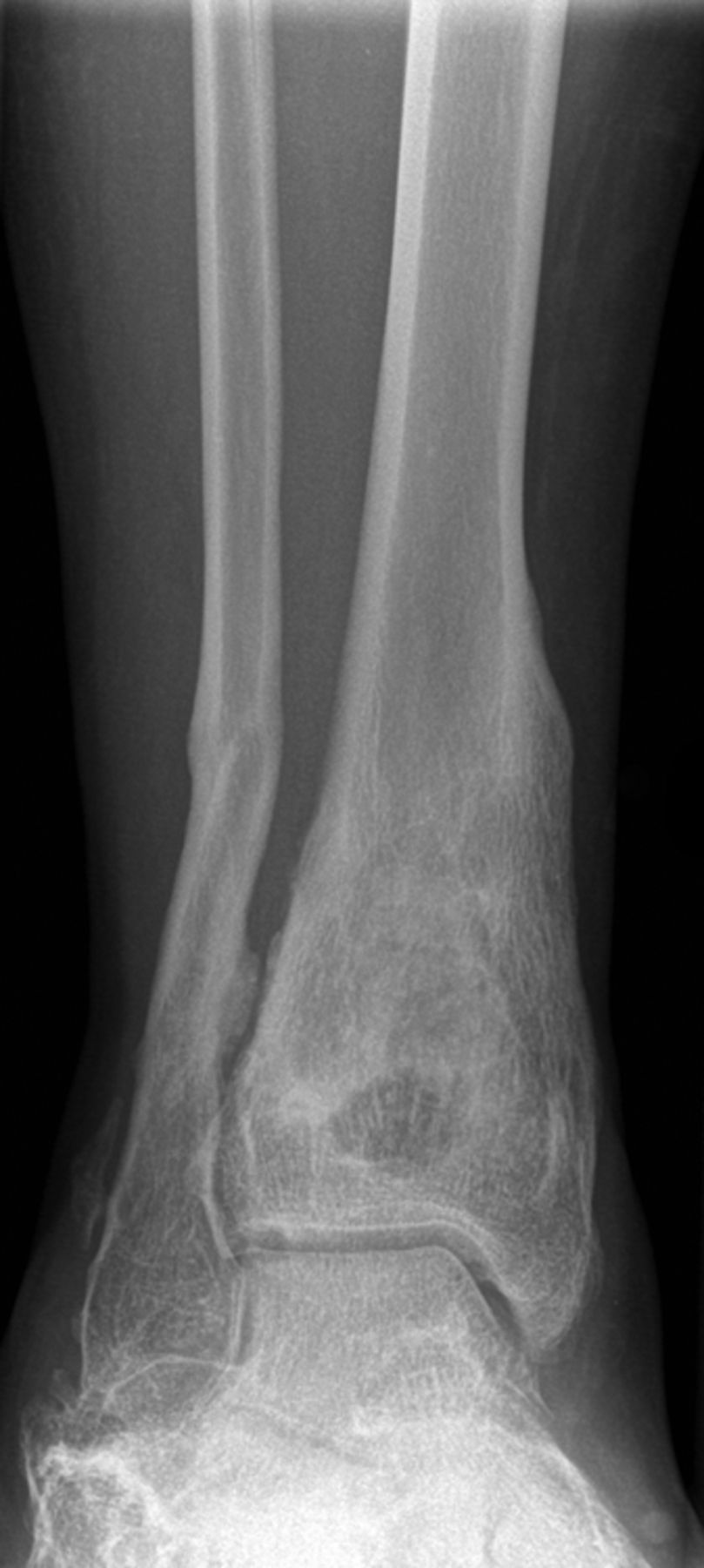 Figs. 5a - 5d 
            Radiographs showing HERAFILL®
beads G (Heraeus Medical GmbH) after implantation into a distal
tibial bone void a) pre-operatively, b) post-operatively, c) three
and d) six months post-operatively.
          