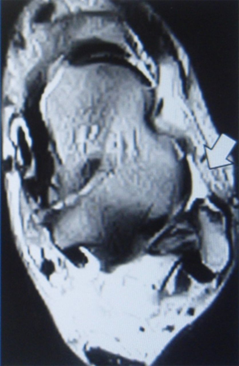 Figs. 1a - 1c 
            Axial T2-weighted images showing
typical ATFL findings (white arrows). T and F denote tibia and fibula,
respectively, the MRI evaluation was undertaken pre-operatively,
and maximum diameters of the anterior talofibular ligaments (ATFLs)
were measured.
          