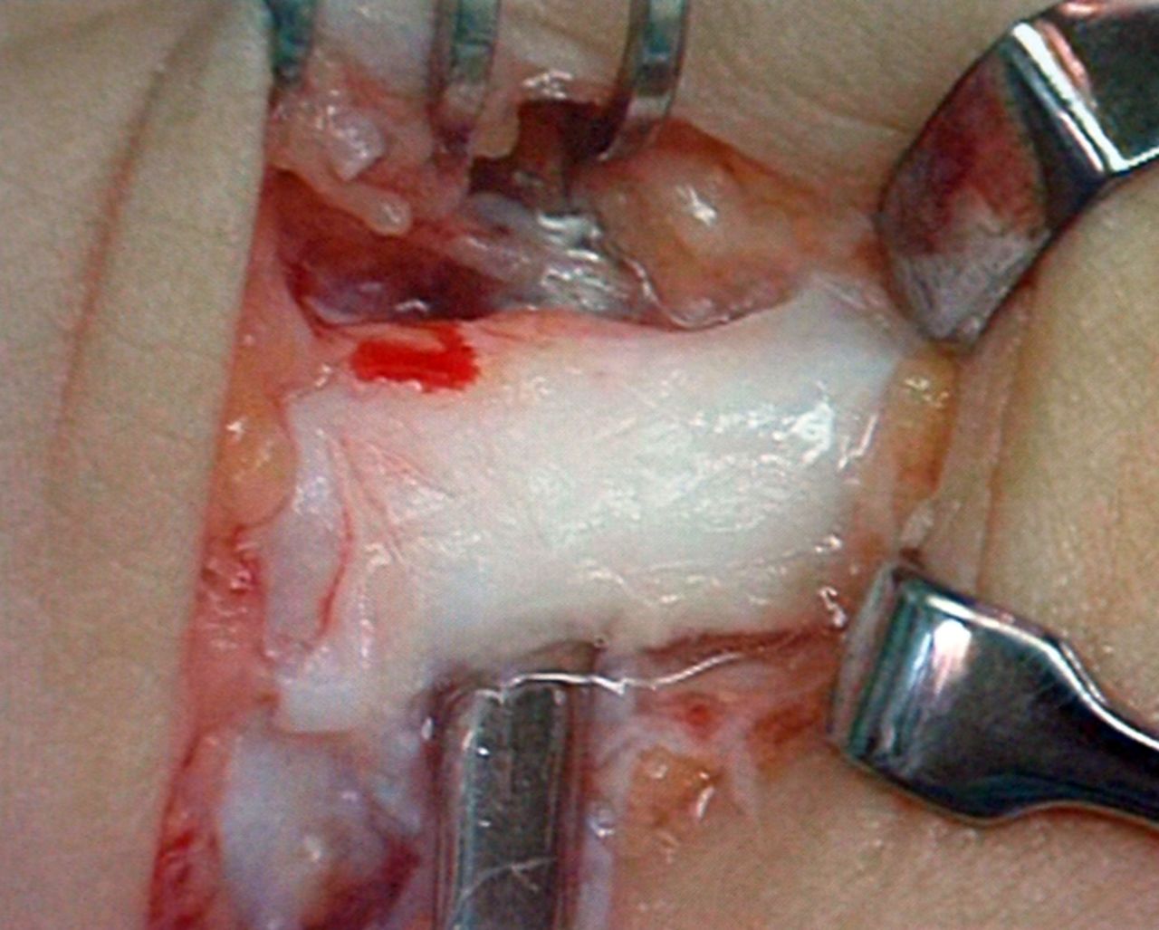 Figs. 2a - 2b 
            Photographs showing the typical
intra-operative appearance of injured anterior talofibular ligaments
(ATFLs), either a) ‘thickened’ or b) ‘thin or absent’.
          