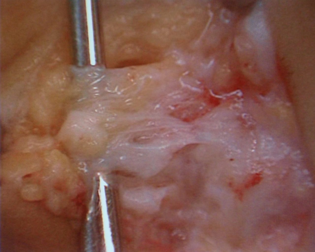 Figs. 2a - 2b 
            Photographs showing the typical
intra-operative appearance of injured anterior talofibular ligaments
(ATFLs), either a) ‘thickened’ or b) ‘thin or absent’.
          