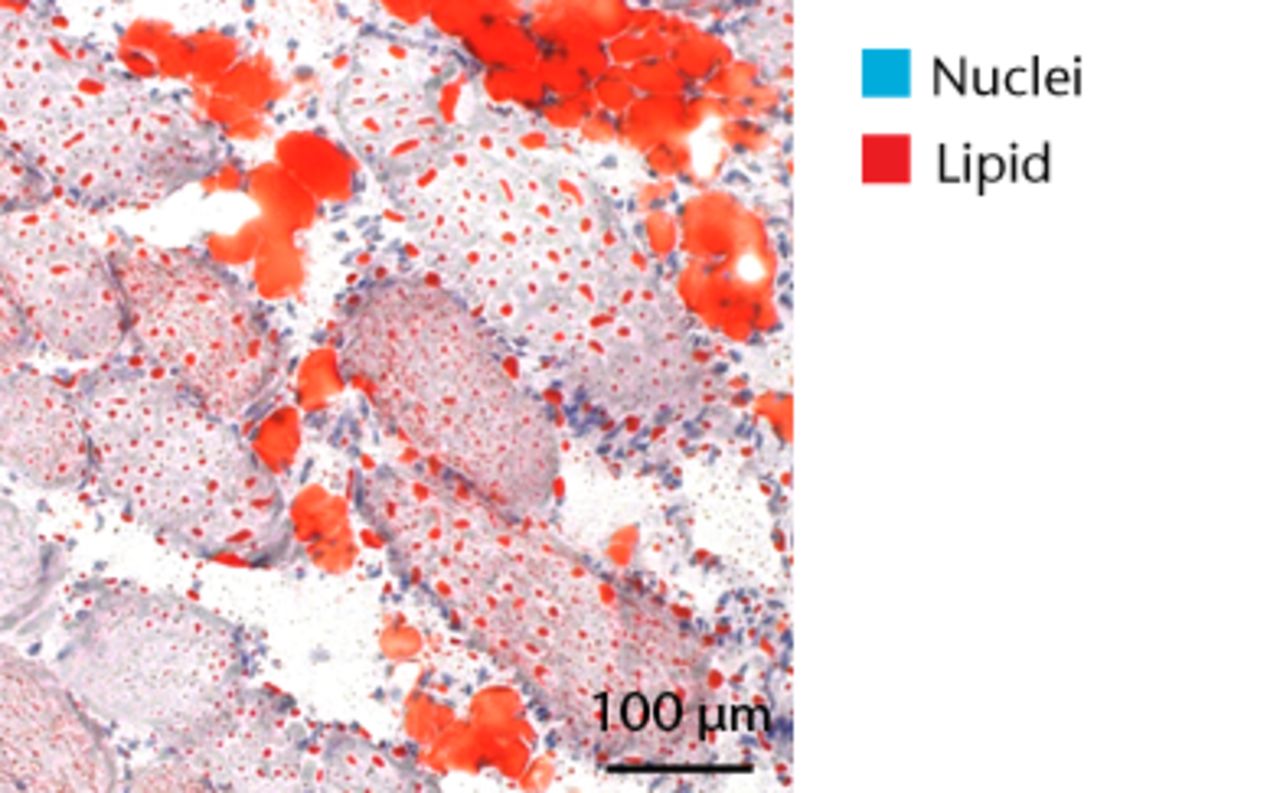 Figs. 5a - 5d 
          Representative Oil red O histology
sections from a) sham-operated control and b) torn rotator cuff
muscles. Blue represents haematoxylin; red, Oil red O. Representative
immunohistochemistry from c) sham-operated control and d) torn rotator
cuff muscles; blue represents nuclei (DAPI); red, extracellular
matrix (WGA lectin); green, lipid (BODIPY); white, macrophages (F4/
80).
        