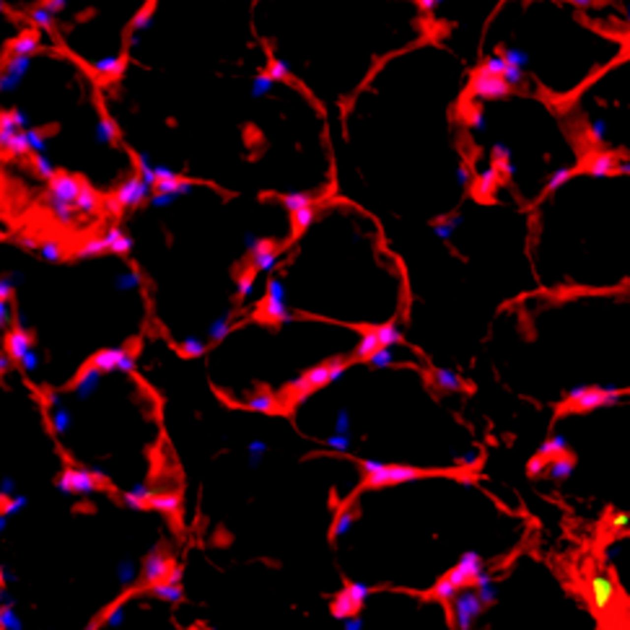 Figs. 5a - 5d 
          Representative Oil red O histology
sections from a) sham-operated control and b) torn rotator cuff
muscles. Blue represents haematoxylin; red, Oil red O. Representative
immunohistochemistry from c) sham-operated control and d) torn rotator
cuff muscles; blue represents nuclei (DAPI); red, extracellular
matrix (WGA lectin); green, lipid (BODIPY); white, macrophages (F4/
80).
        