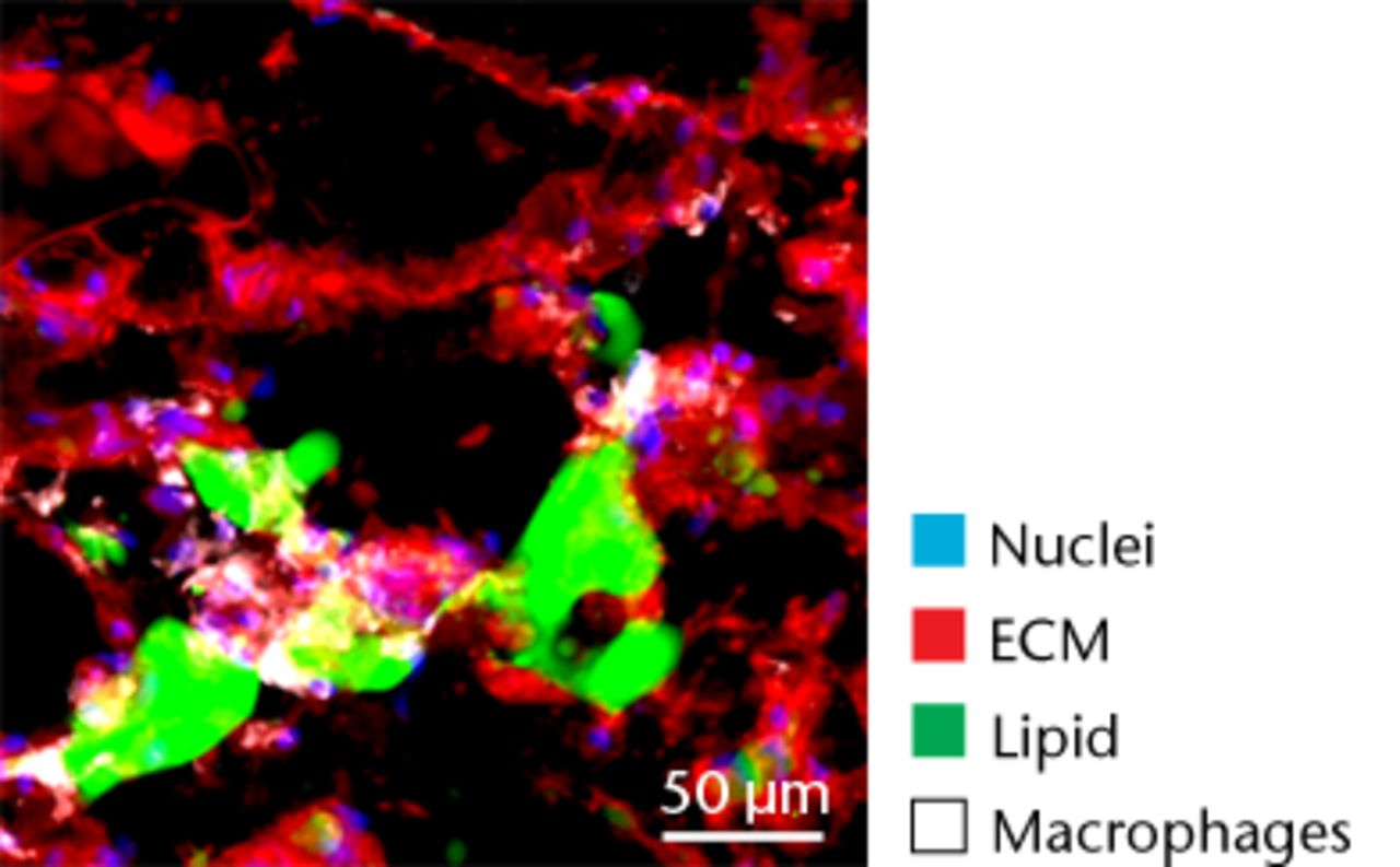 Figs. 5a - 5d 
          Representative Oil red O histology
sections from a) sham-operated control and b) torn rotator cuff
muscles. Blue represents haematoxylin; red, Oil red O. Representative
immunohistochemistry from c) sham-operated control and d) torn rotator
cuff muscles; blue represents nuclei (DAPI); red, extracellular
matrix (WGA lectin); green, lipid (BODIPY); white, macrophages (F4/
80).
        