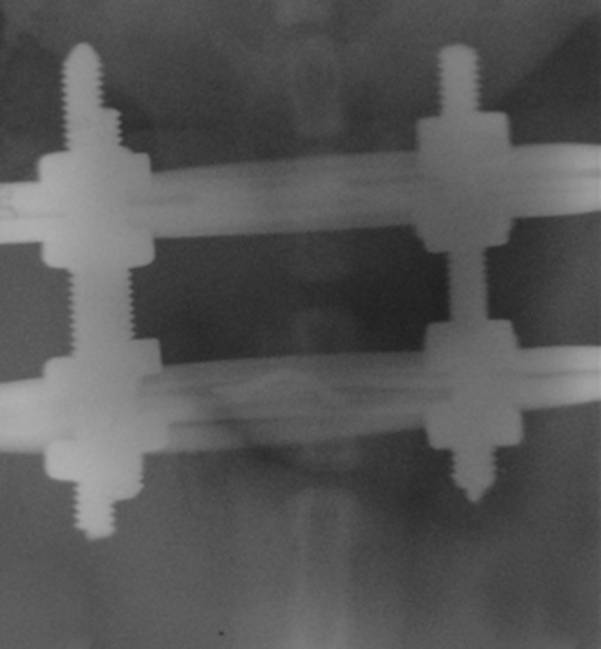 Figs. 1a - 1c 
            Radiographs of asymmetrically
loaded rat tail intervertebral discs with a) 10°, b) 30° and c)
50° of deformity.
          