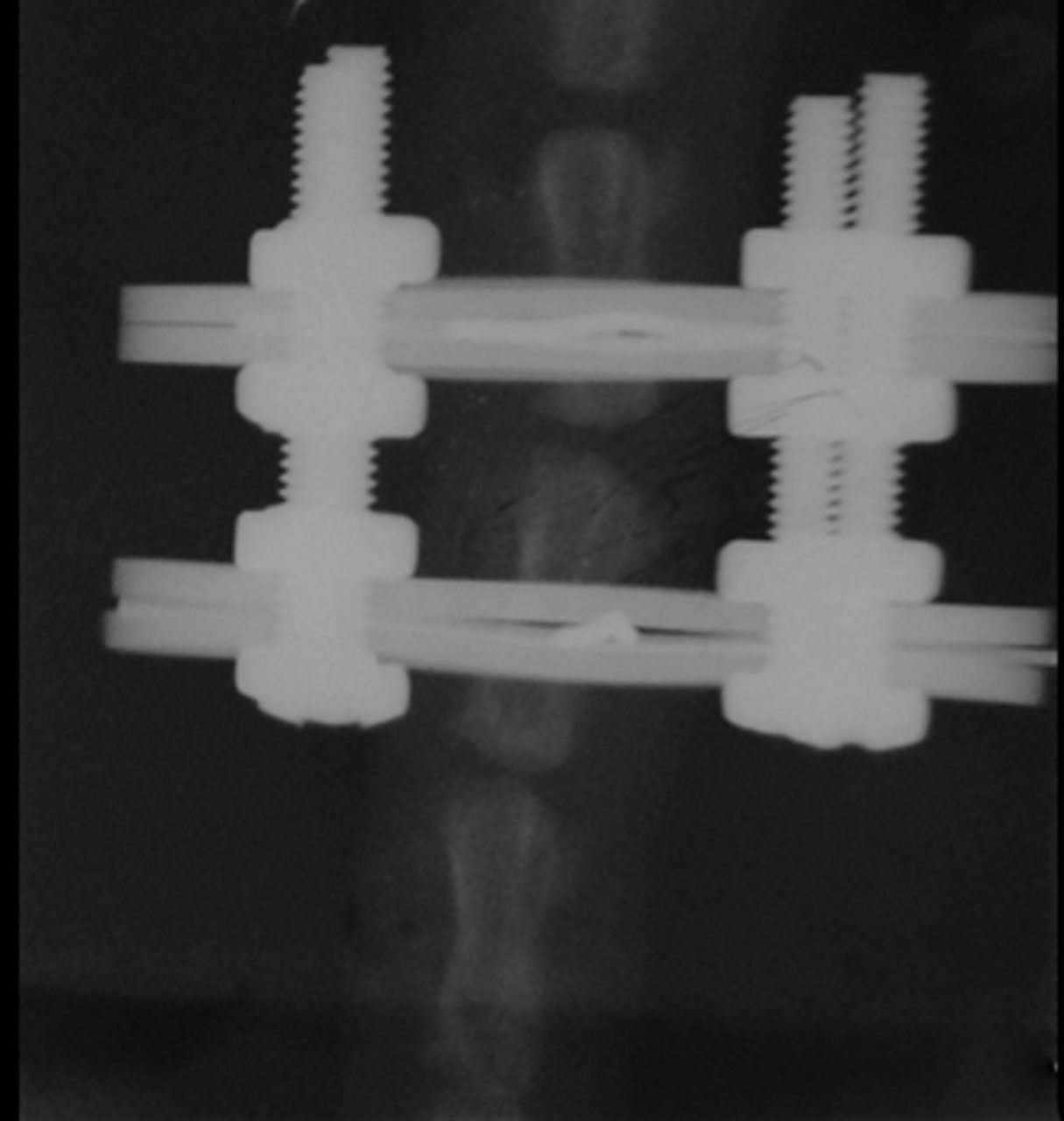 Figs. 1a - 1c 
            Radiographs of asymmetrically
loaded rat tail intervertebral discs with a) 10°, b) 30° and c)
50° of deformity.
          