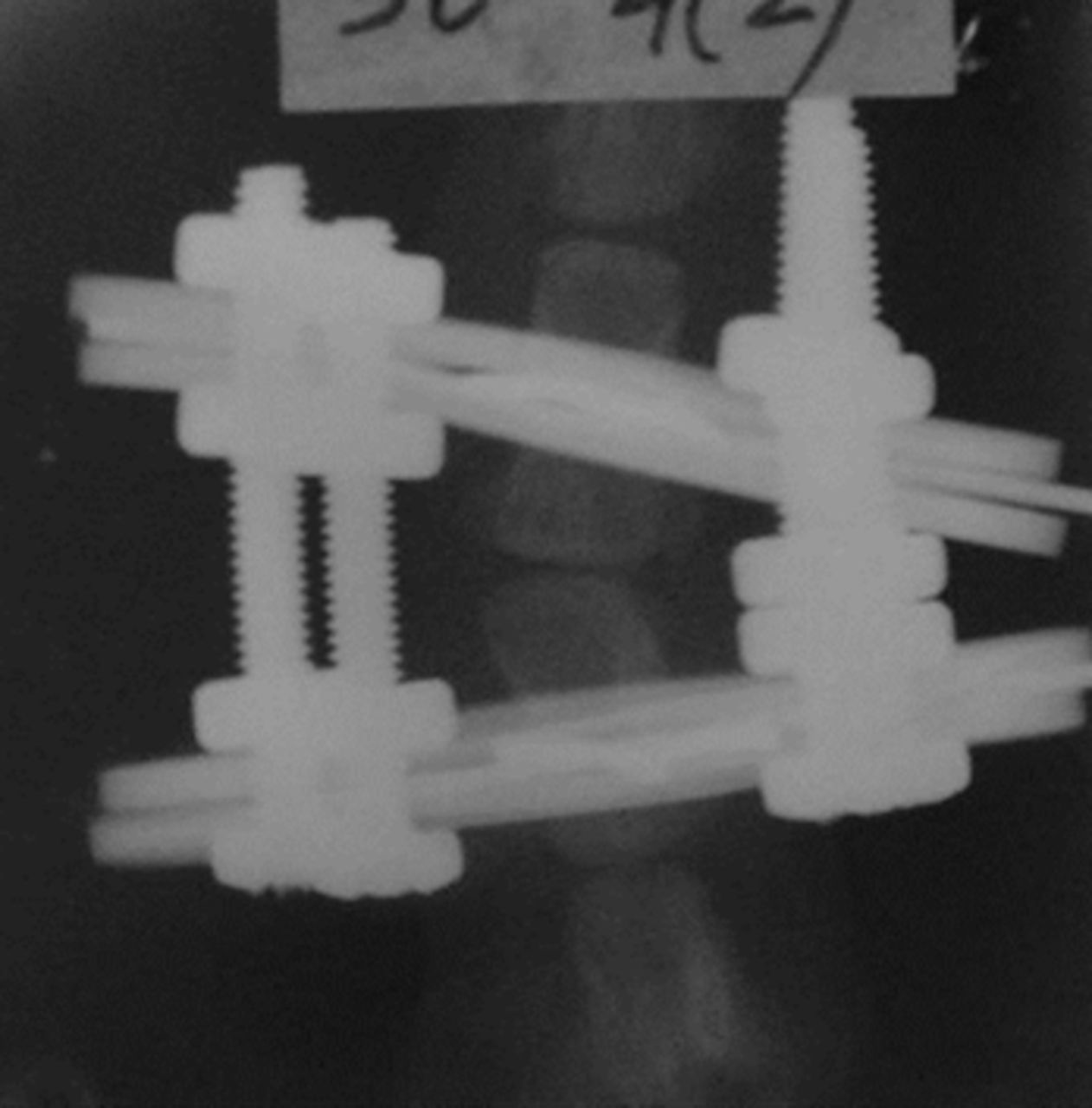 Figs. 1a - 1c 
            Radiographs of asymmetrically
loaded rat tail intervertebral discs with a) 10°, b) 30° and c)
50° of deformity.
          