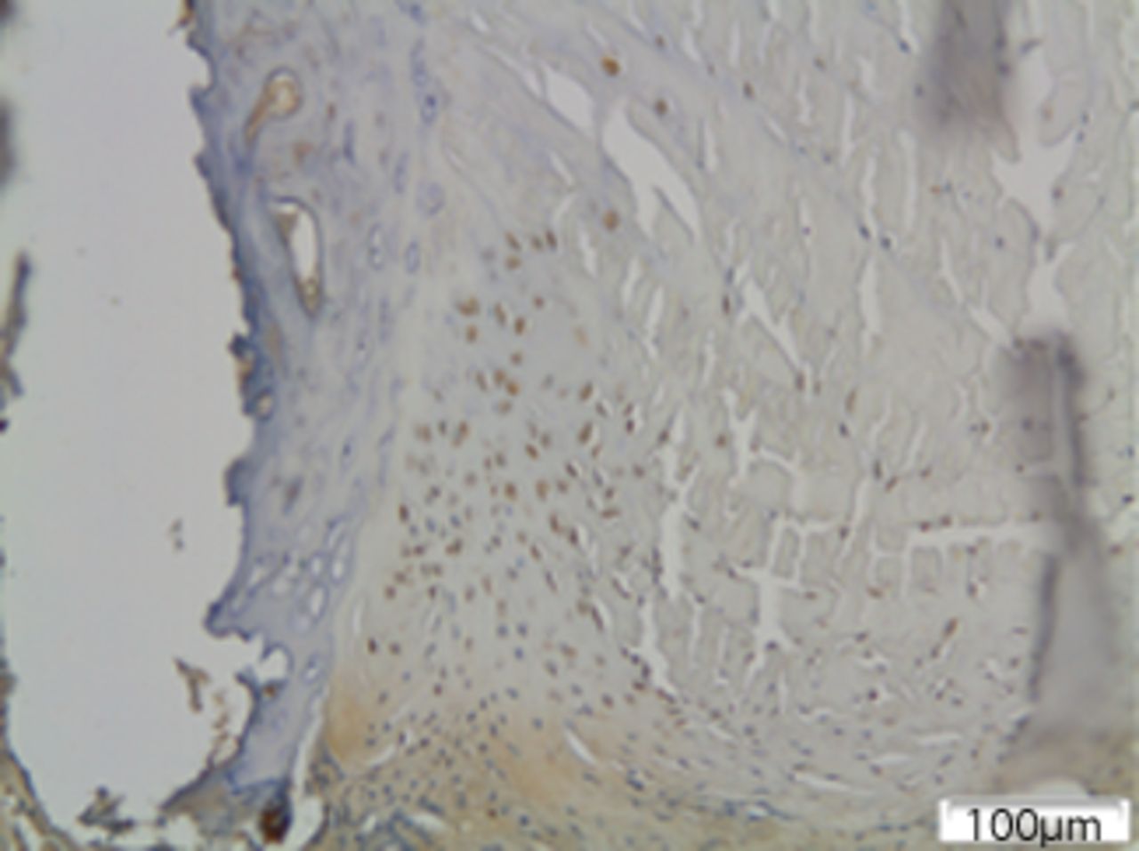 Figs. 5a - 5c 
            Immunohistochemical images of
a) the periphery of annulus fibrosus in group I with a small number
of fibroblasts expressing MMP12; b) the periphery of annulus fibrosus
in group II, where the number of disc cells expressing MMP12 is increased
and includes both fibroblasts and chondrocytes and c) the periphery
of annulus fibrosus in group III, where disc cells are absent from
the periphery of the annulus fibrosus and most of the remaining
cells from central area are expressing MMP12.
          