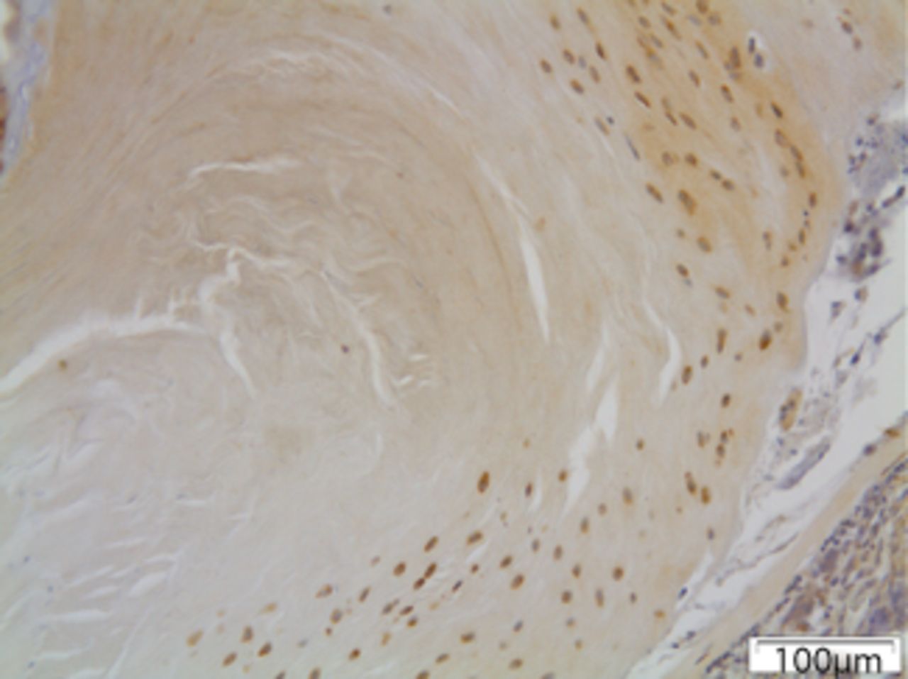 Figs. 5a - 5c 
            Immunohistochemical images of
a) the periphery of annulus fibrosus in group I with a small number
of fibroblasts expressing MMP12; b) the periphery of annulus fibrosus
in group II, where the number of disc cells expressing MMP12 is increased
and includes both fibroblasts and chondrocytes and c) the periphery
of annulus fibrosus in group III, where disc cells are absent from
the periphery of the annulus fibrosus and most of the remaining
cells from central area are expressing MMP12.
          