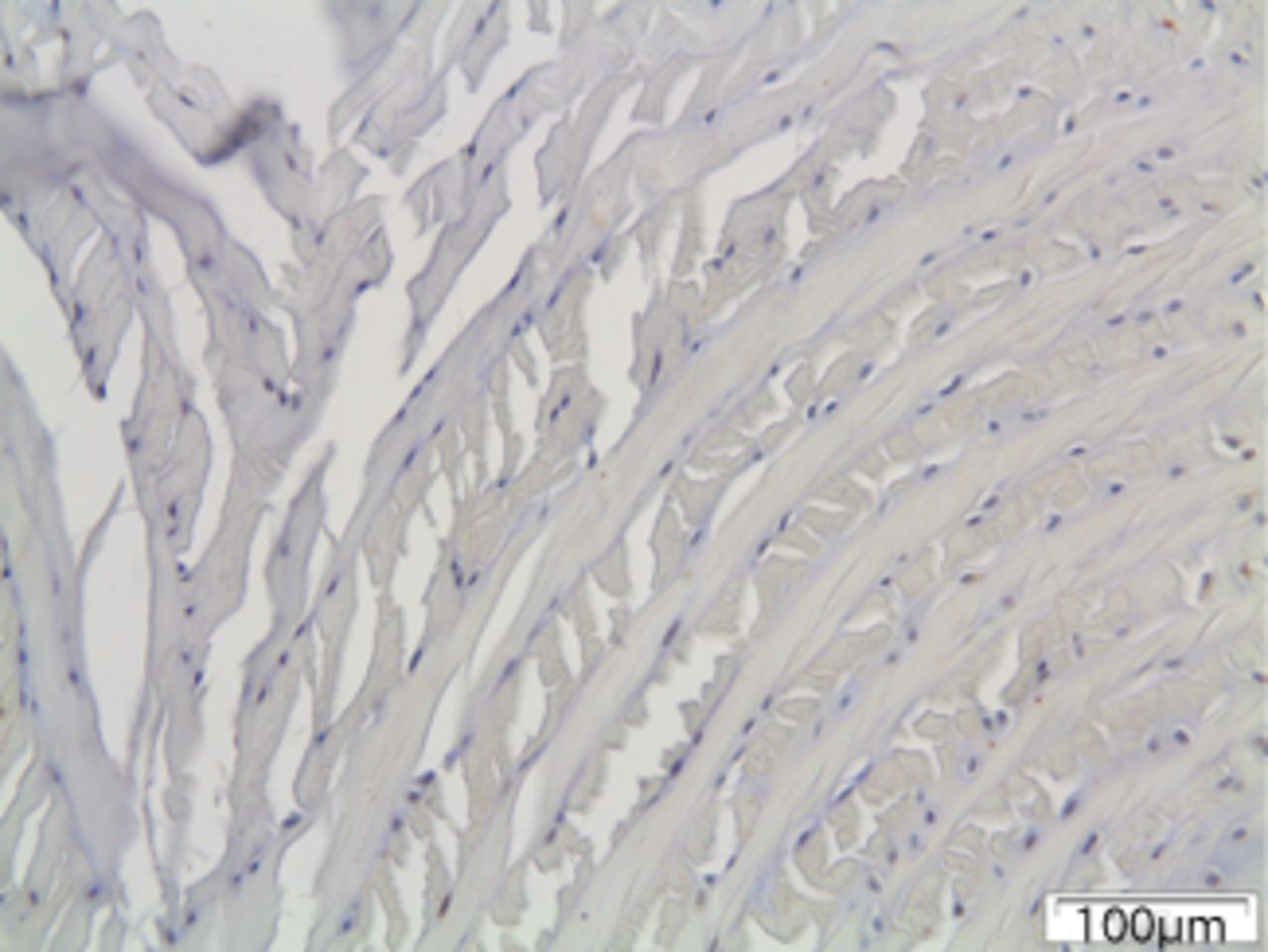 Figs. 6a - 6c 
            Immunohistochemical images of
the annulus fibrosus of the control group with a) absence of expression
of MMP12, b) the convex side of a disc specimen from group III,
where a large number of disc cells, both fibroblasts and chondrocytes
are expressing MMP12: note the disorganisation of microstructure
of the lamellae of annulus fibrosus, and c) the concave side of
the same disc specimen as in Figure 6b, where all disc cells are
expressing MMP12. A reduction of cell population and a complete
disorganisation of microstructure are evident at the concave side.
          