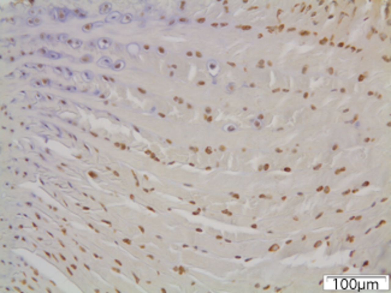 Figs. 6a - 6c 
            Immunohistochemical images of
the annulus fibrosus of the control group with a) absence of expression
of MMP12, b) the convex side of a disc specimen from group III,
where a large number of disc cells, both fibroblasts and chondrocytes
are expressing MMP12: note the disorganisation of microstructure
of the lamellae of annulus fibrosus, and c) the concave side of
the same disc specimen as in Figure 6b, where all disc cells are
expressing MMP12. A reduction of cell population and a complete
disorganisation of microstructure are evident at the concave side.
          