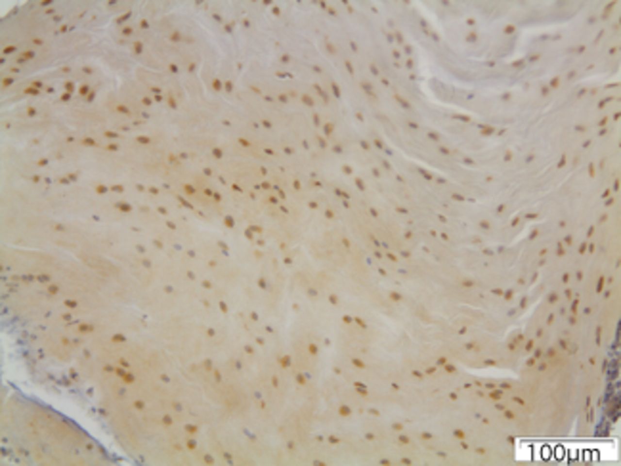 Figs. 6a - 6c 
            Immunohistochemical images of
the annulus fibrosus of the control group with a) absence of expression
of MMP12, b) the convex side of a disc specimen from group III,
where a large number of disc cells, both fibroblasts and chondrocytes
are expressing MMP12: note the disorganisation of microstructure
of the lamellae of annulus fibrosus, and c) the concave side of
the same disc specimen as in Figure 6b, where all disc cells are
expressing MMP12. A reduction of cell population and a complete
disorganisation of microstructure are evident at the concave side.
          