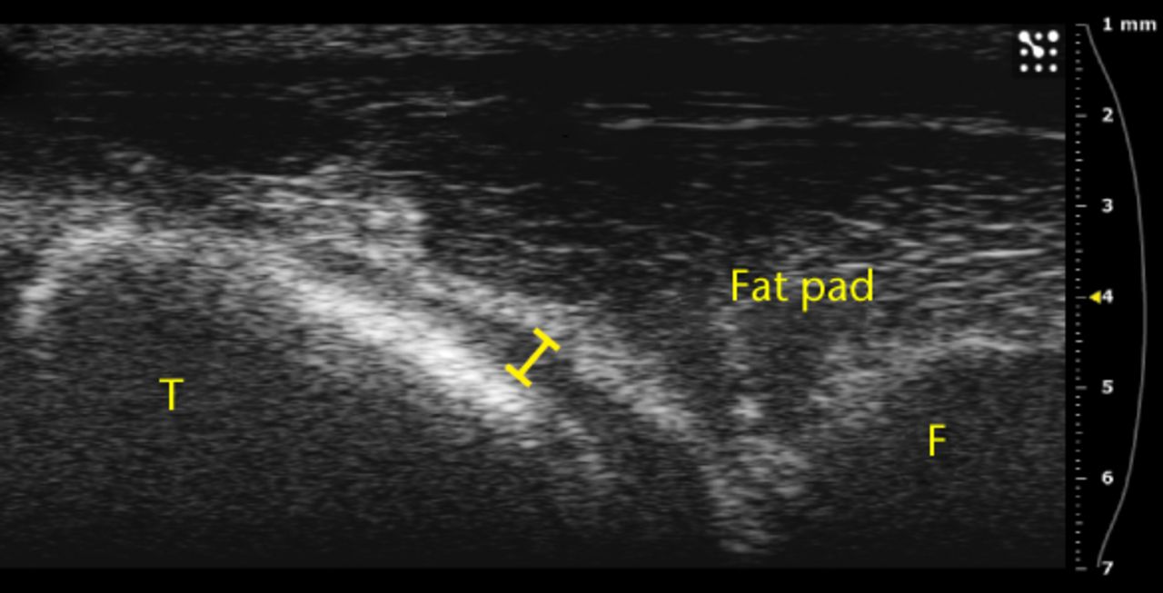 Figs. 3a - 3b 
          Ultrasound images showing substantial
separation of the fat pad from the tibia a) before and b) after
an injection.
        