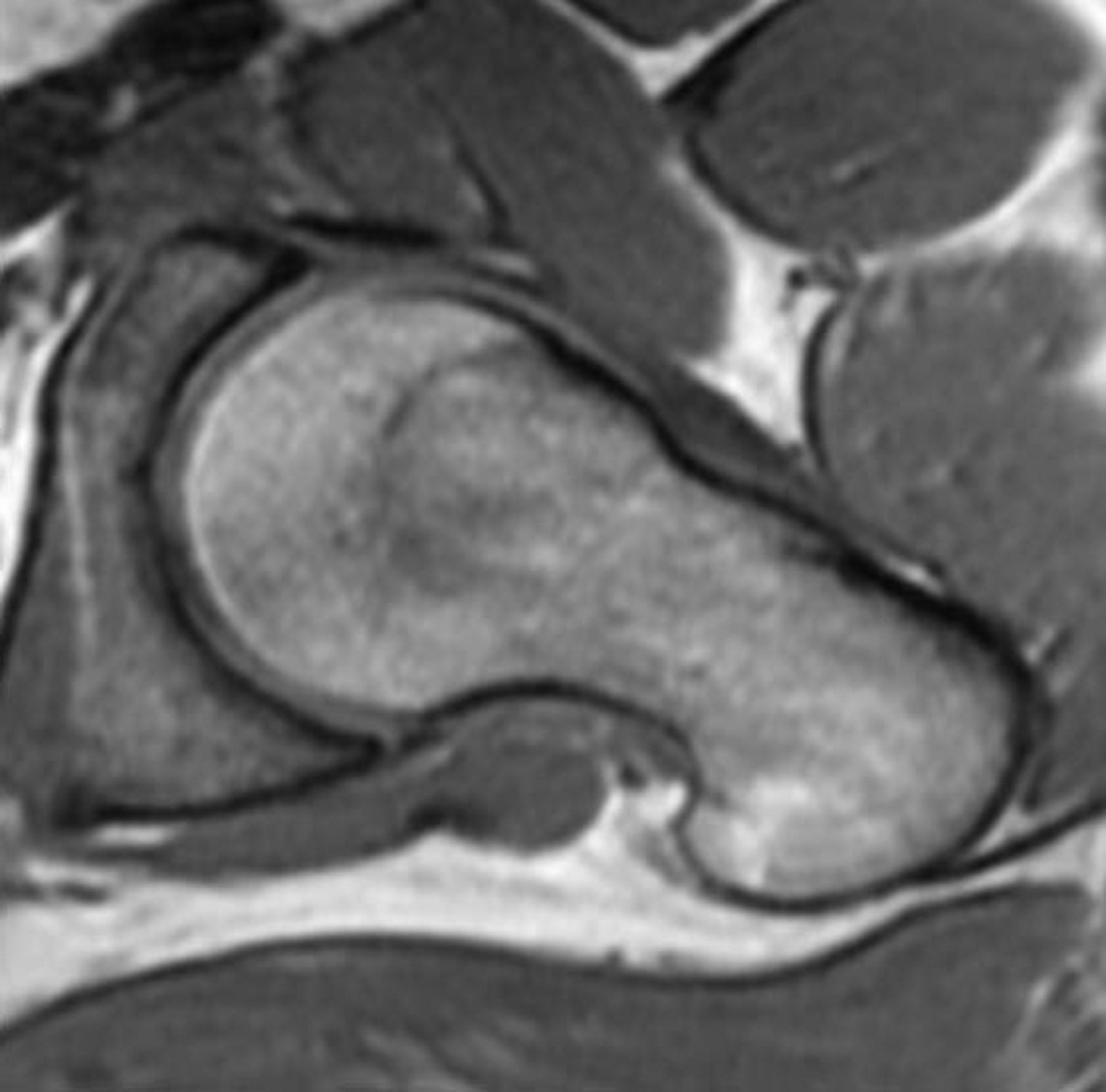 Figs. 1a - 1c 
           a) A 3D surface rendered
image of a proximal femur, with the 3:00 (anterior) and 1:30 (anterosuperior)
planes superimposed. MRI images representative of b) the 3:00 and
c) 1:30 imaging planes.
        