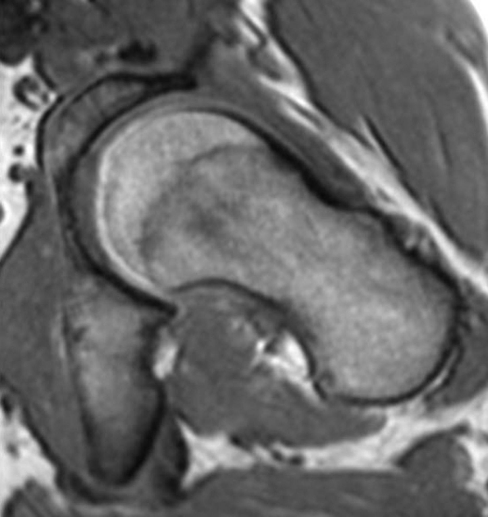 Figs. 1a - 1c 
           a) A 3D surface rendered
image of a proximal femur, with the 3:00 (anterior) and 1:30 (anterosuperior)
planes superimposed. MRI images representative of b) the 3:00 and
c) 1:30 imaging planes.
        